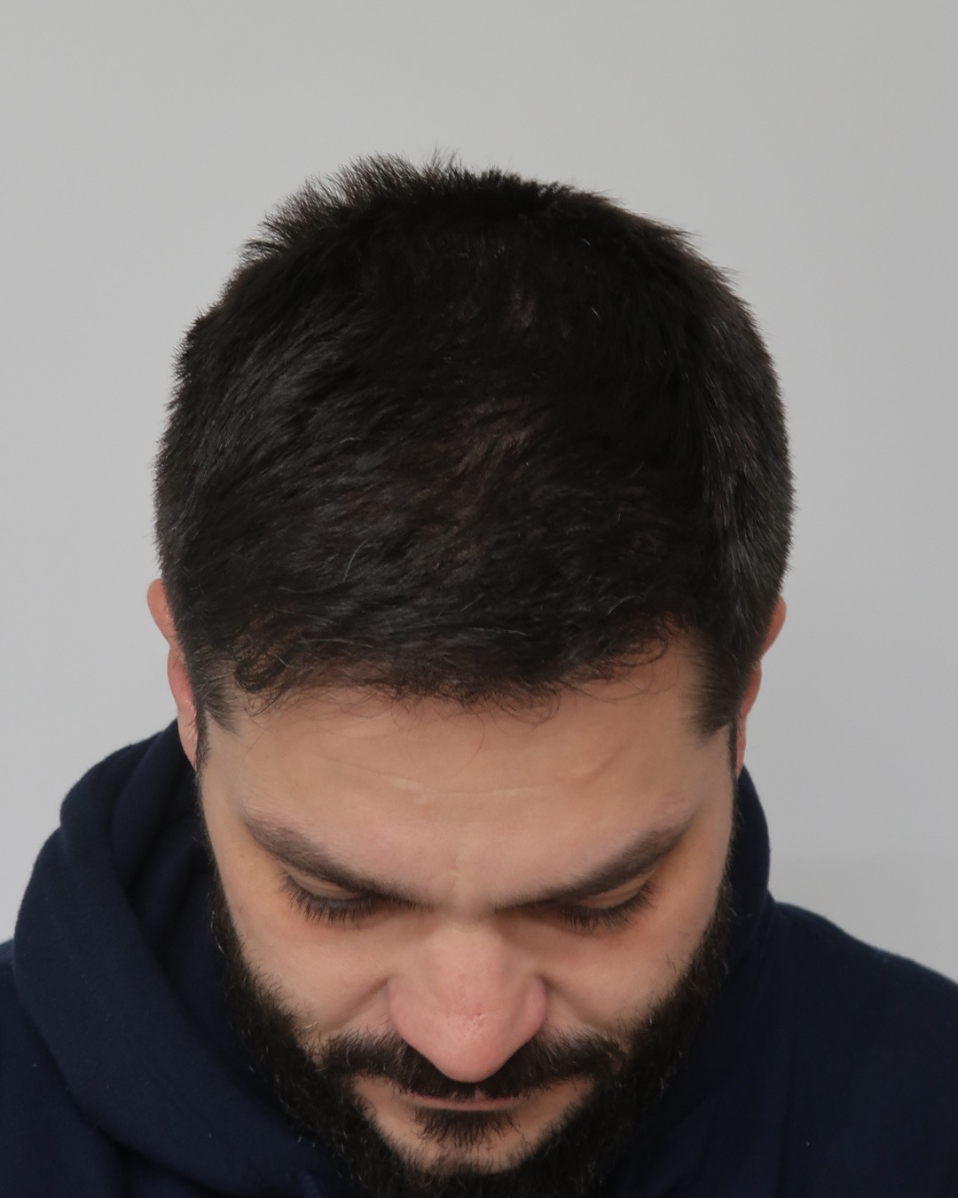 Resultado de transplante capilar antes e depois na Clínica Câmara Lopes no Brasil 10