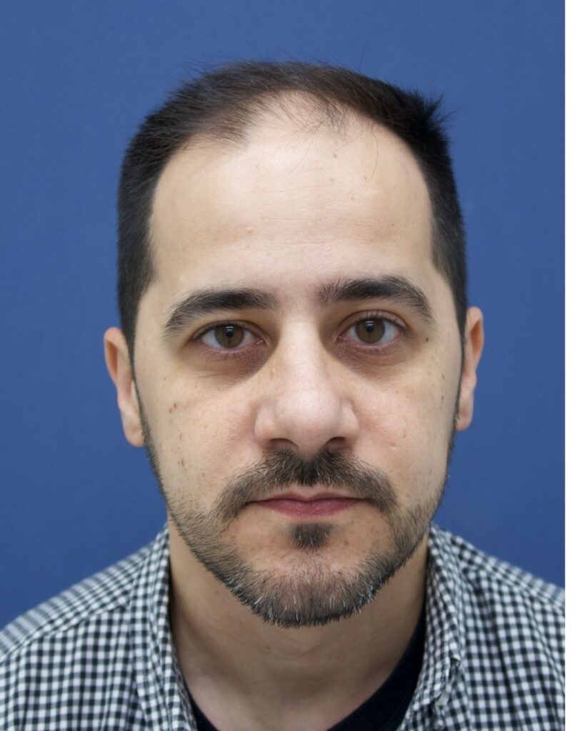 Resultado de transplante capilar antes e depois na Clínica Câmara Lopes no Brasil 5