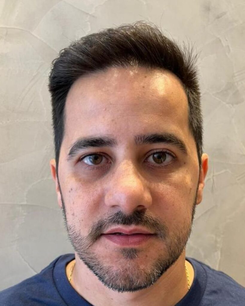 Resultado de transplante capilar antes e depois na Clínica Câmara Lopes no Brasil 6