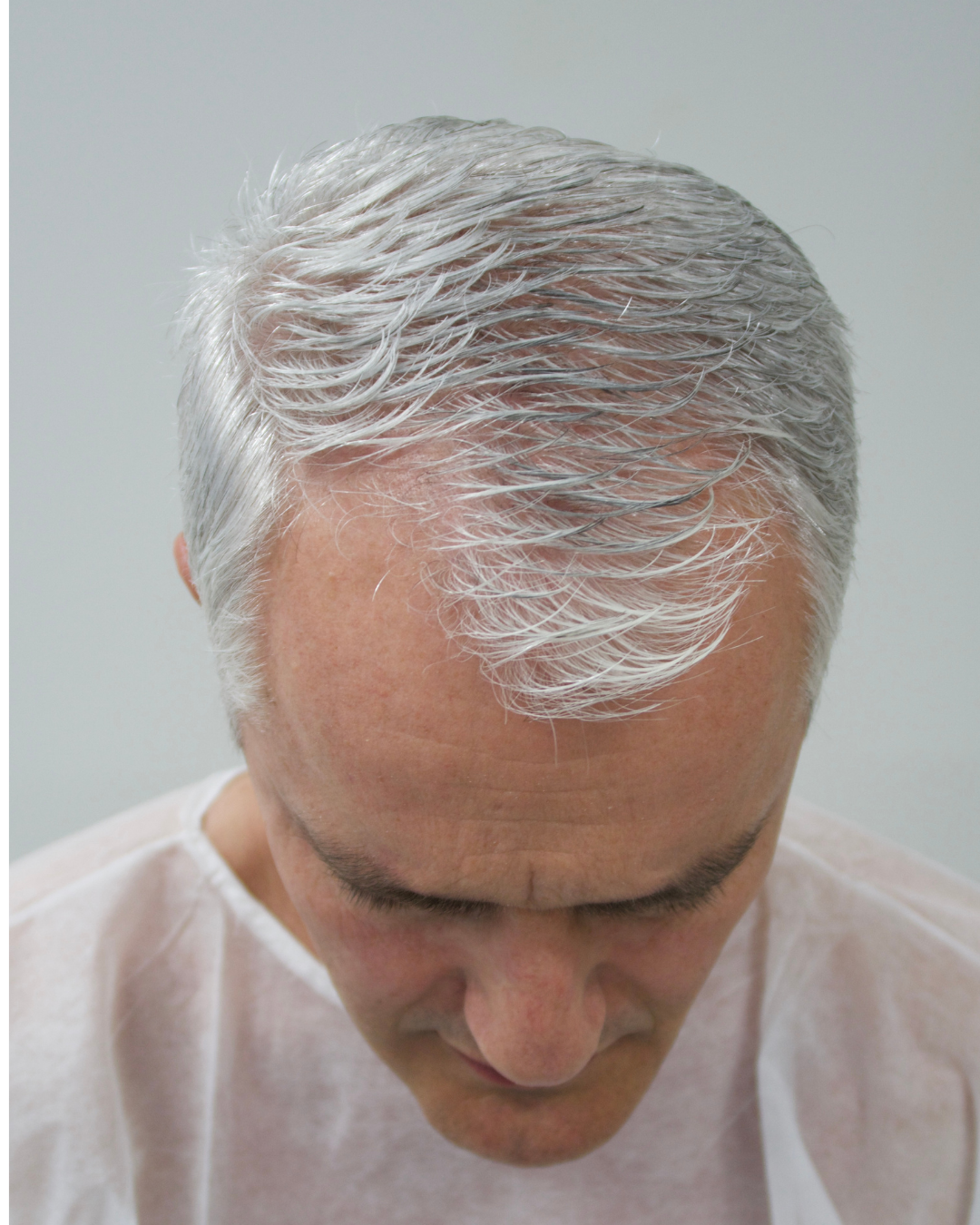 No-Shave FUE, 3700 grafts, before