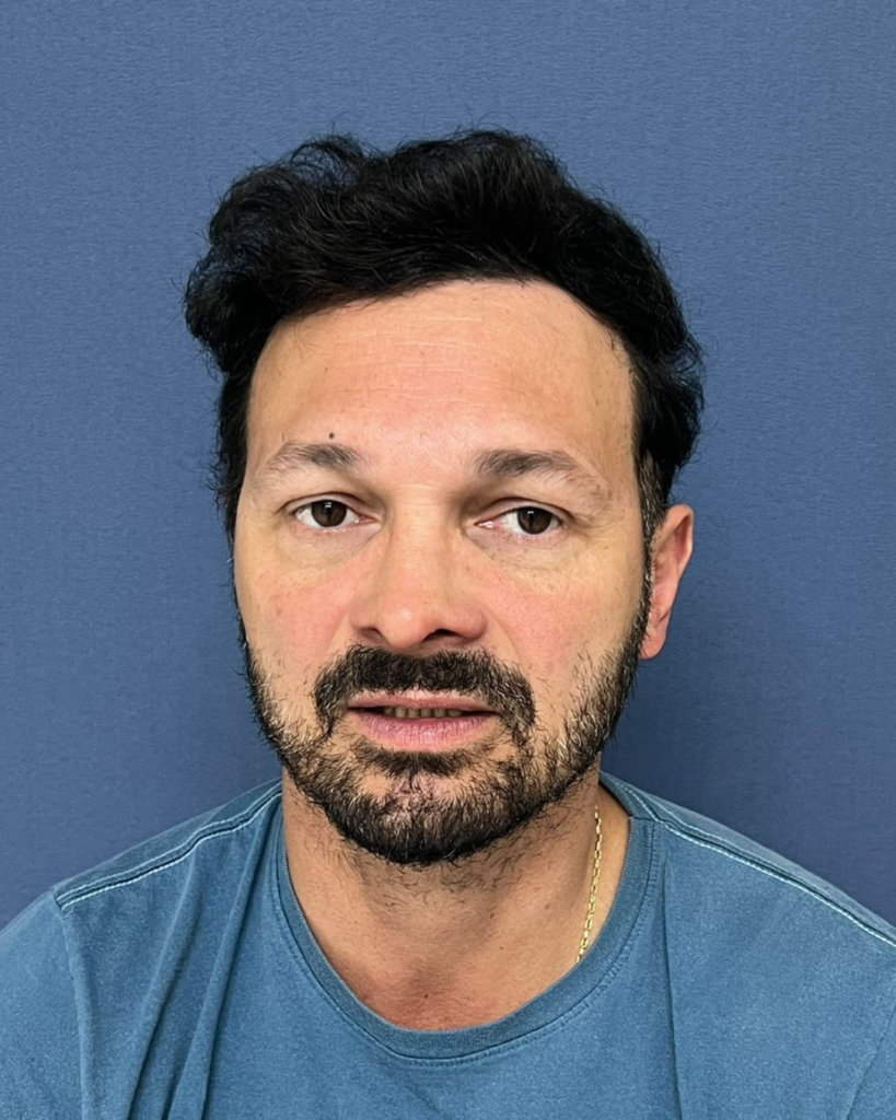 No-Shave FUE, 5200 grafts, after