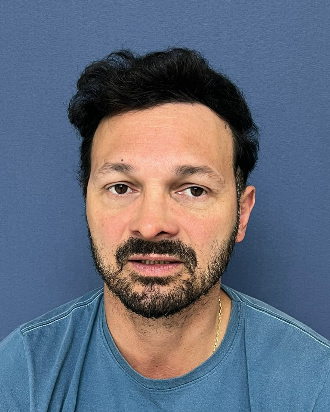 No-Shave FUE, 5200 grafts, after
