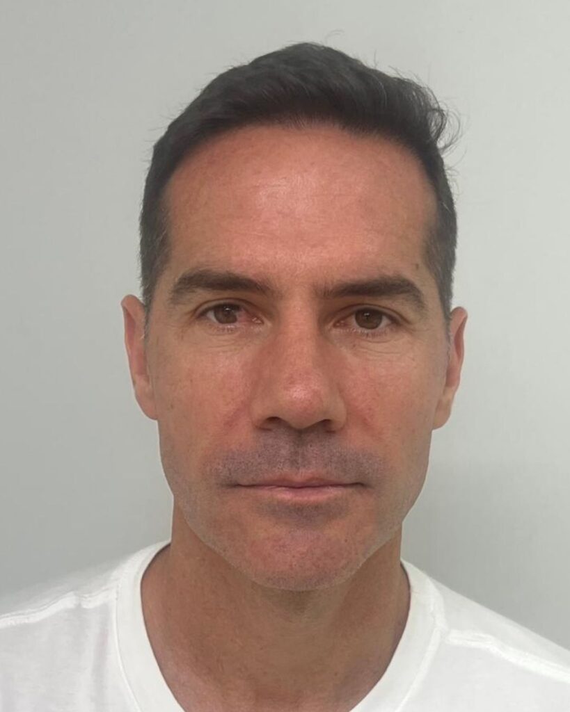 Resultado de transplante capilar antes e depois na Clínica Câmara Lopes no Brasil 4