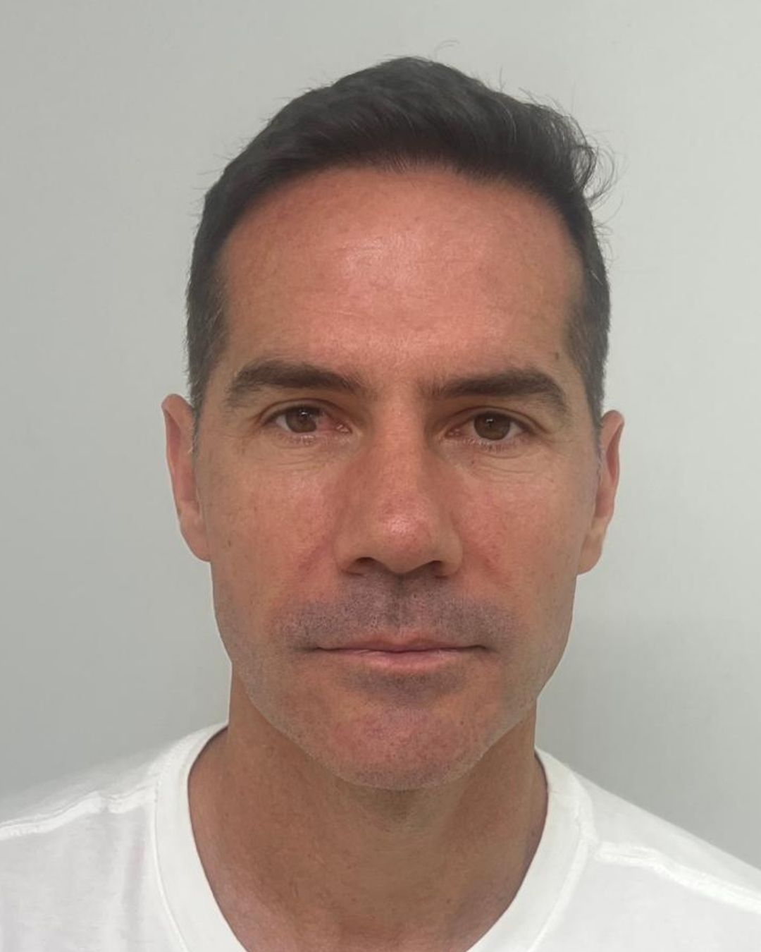 Resultado de transplante capilar antes e depois na Clínica Câmara Lopes no Brasil 4