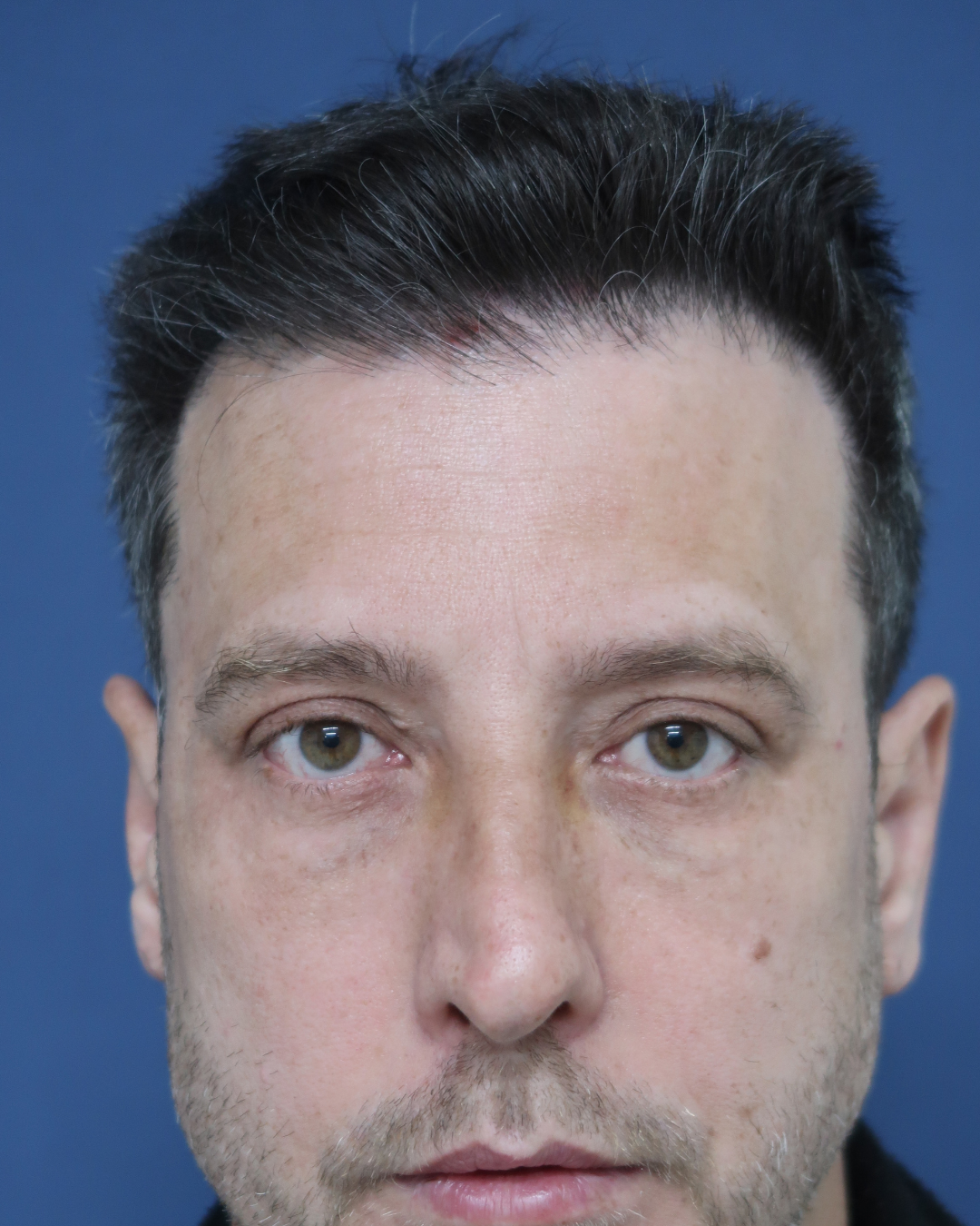 No-Shave FUE, 3700 grafts, before