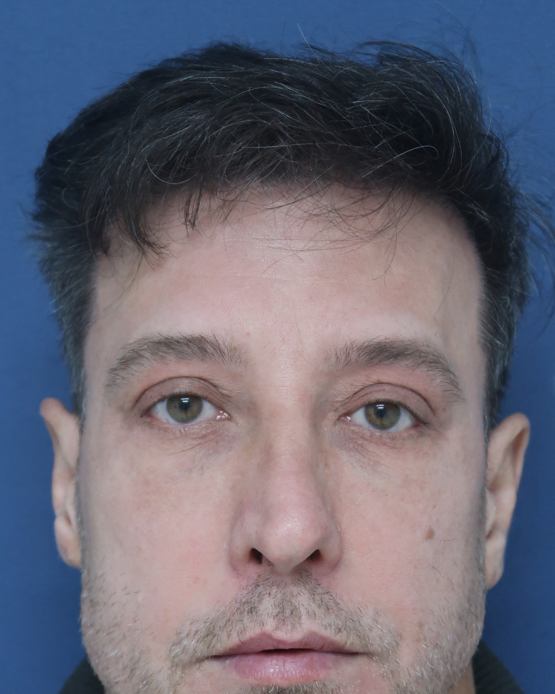No-Shave FUE, 3700 grafts, after