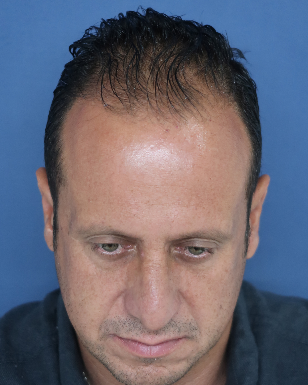 No-Shave FUE, 3900 grafts, before