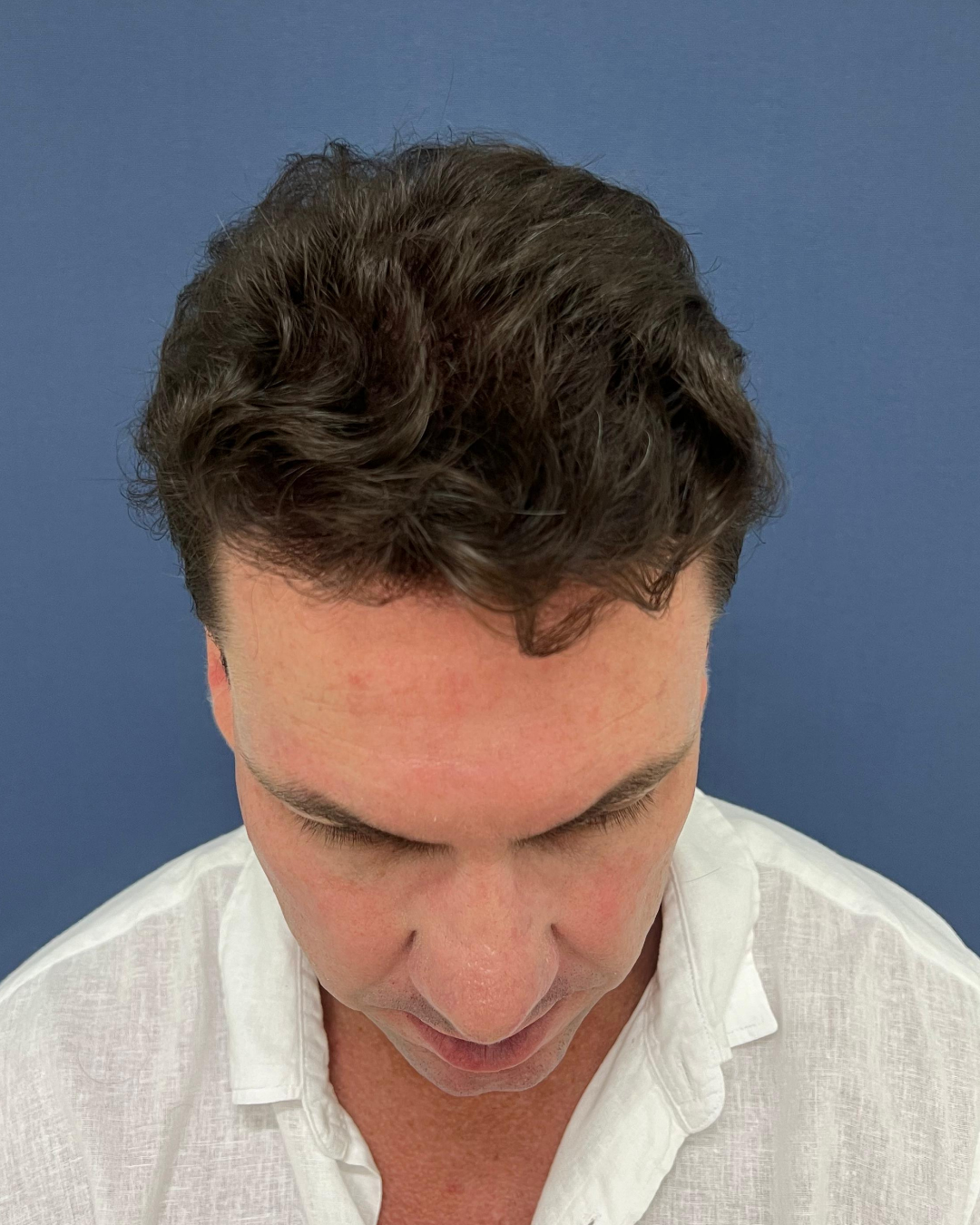 No-Shave FUE, 5500 grafts, after