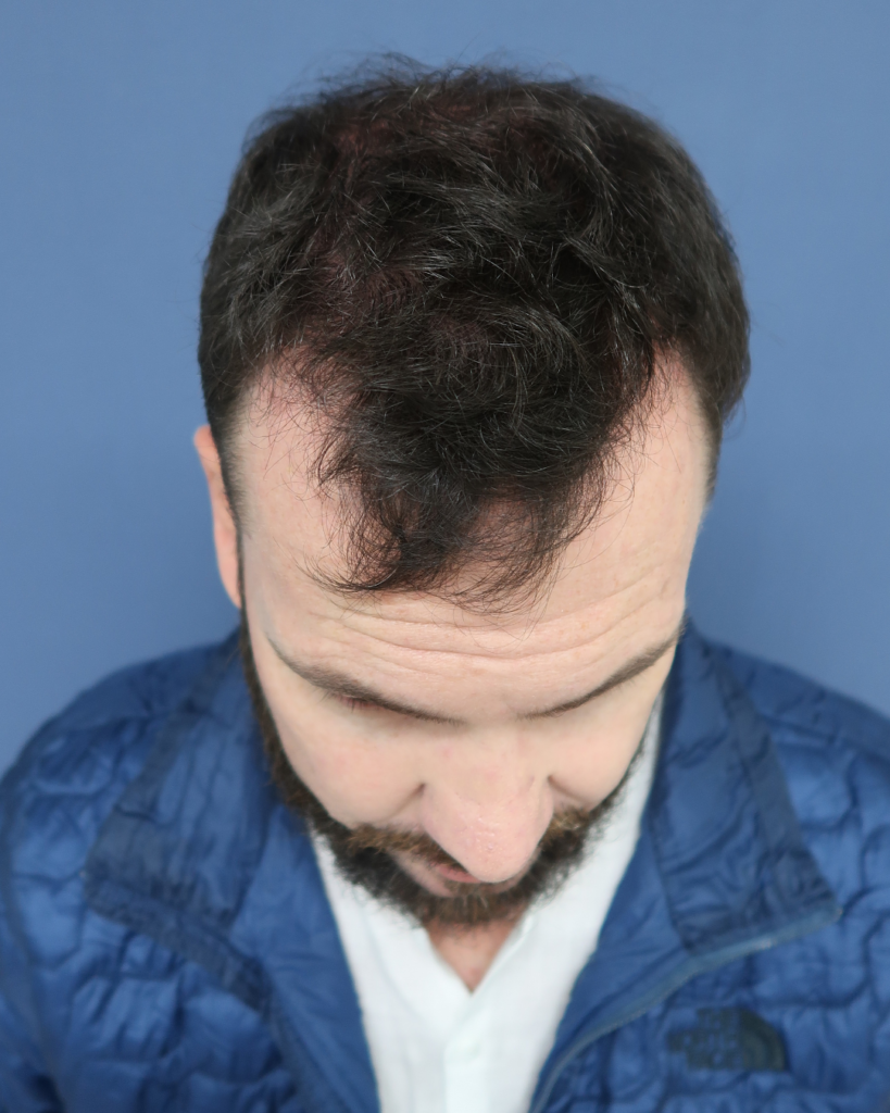 No-Shave FUE, 5500 grafts, before