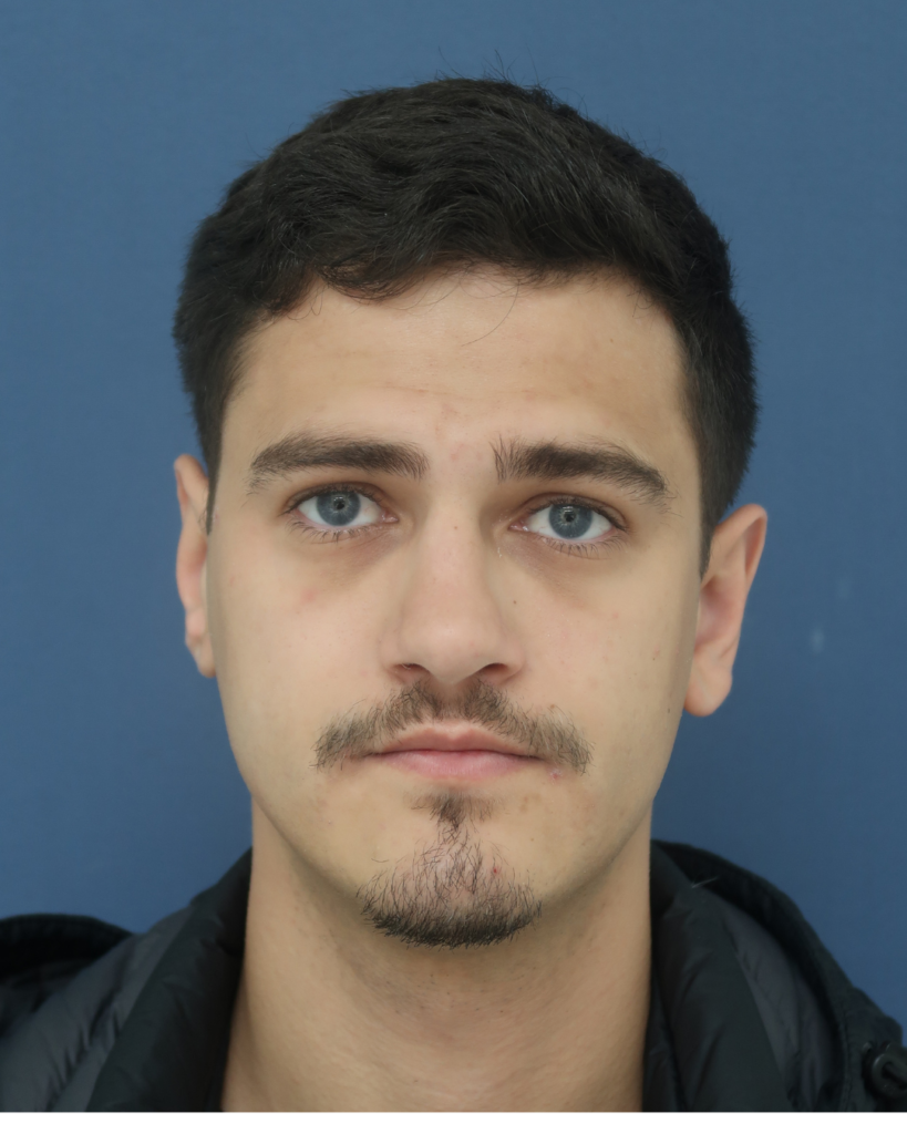 No-Shave FUE, 2600 grafts, after