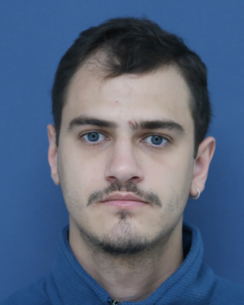 No-Shave FUE, 2600 grafts, before