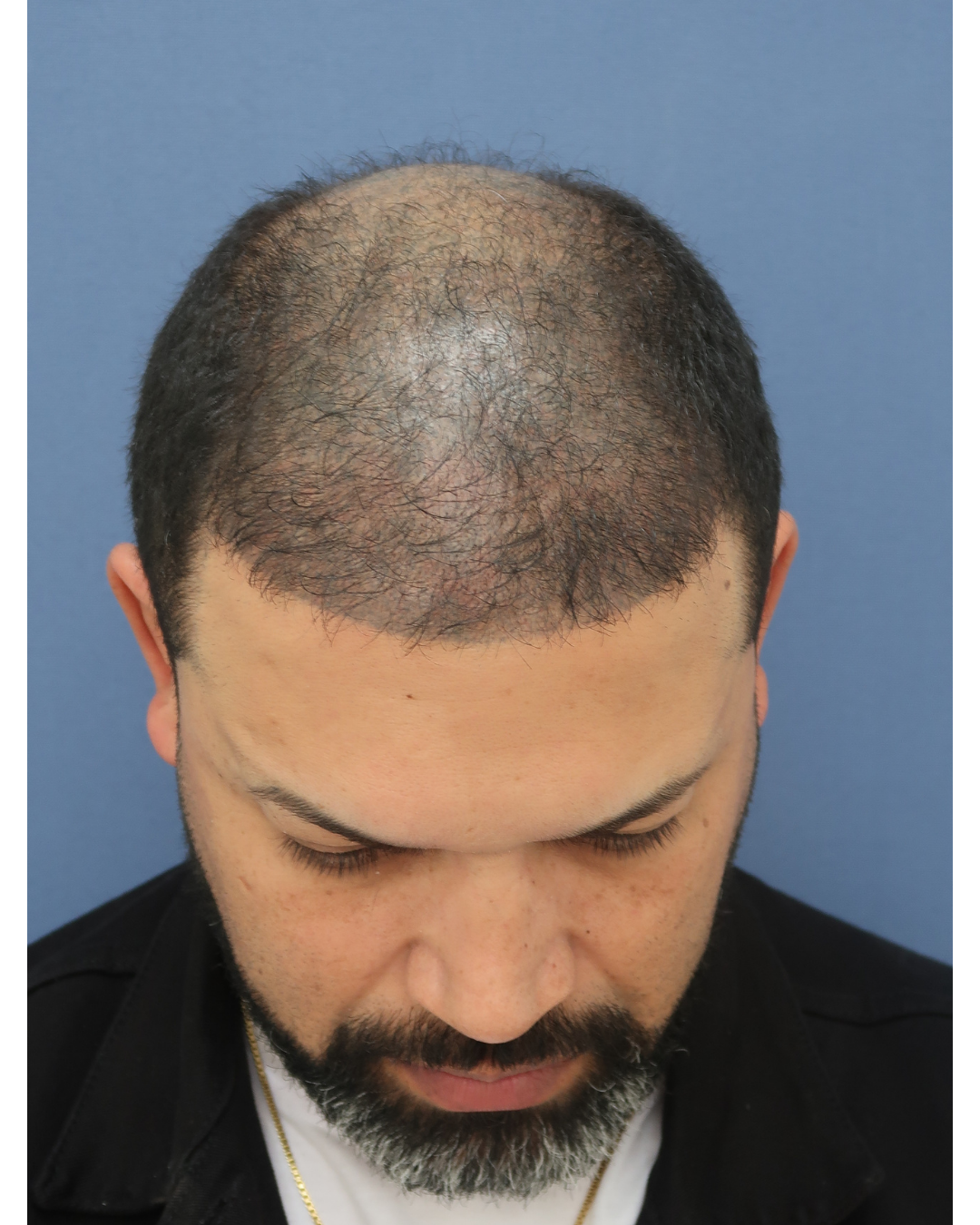 No-Shave FUE, 6800 grafts, before