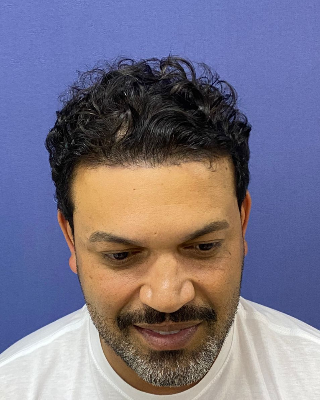 No-Shave FUE, 6800 grafts, after