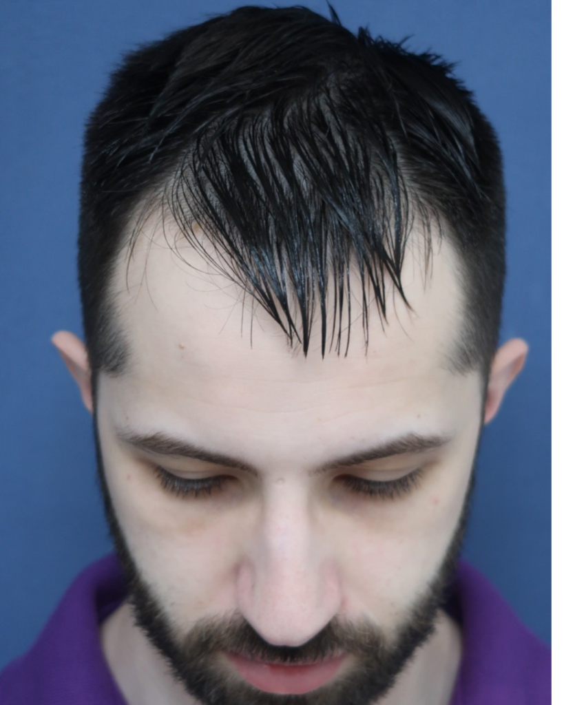 No-Shave FUE, 2487 grafts, before