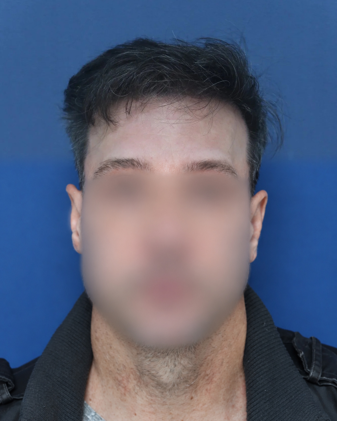 3700-hairline-temples-after-face-blurred