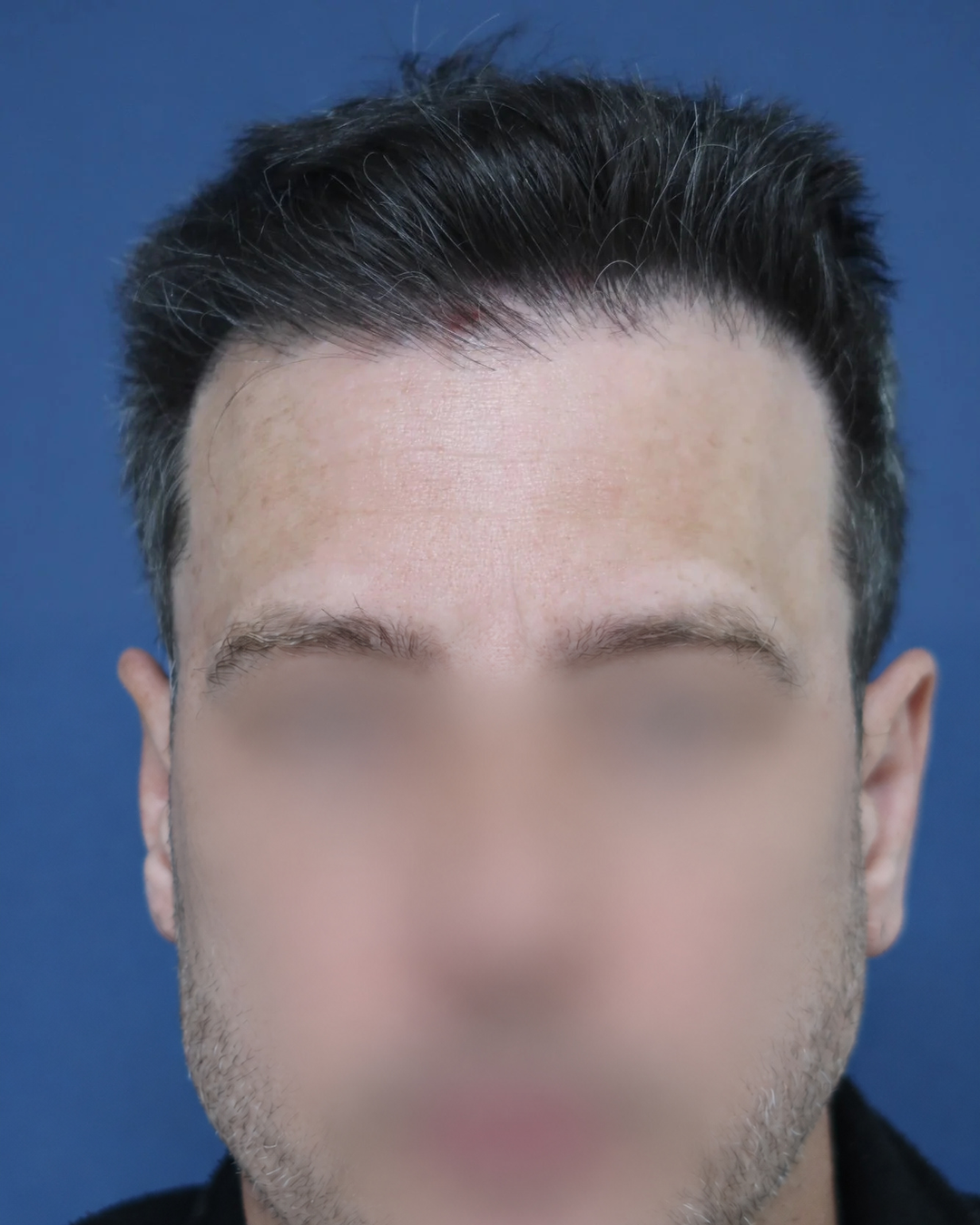 3700-hairline-temples-before-face-blurred