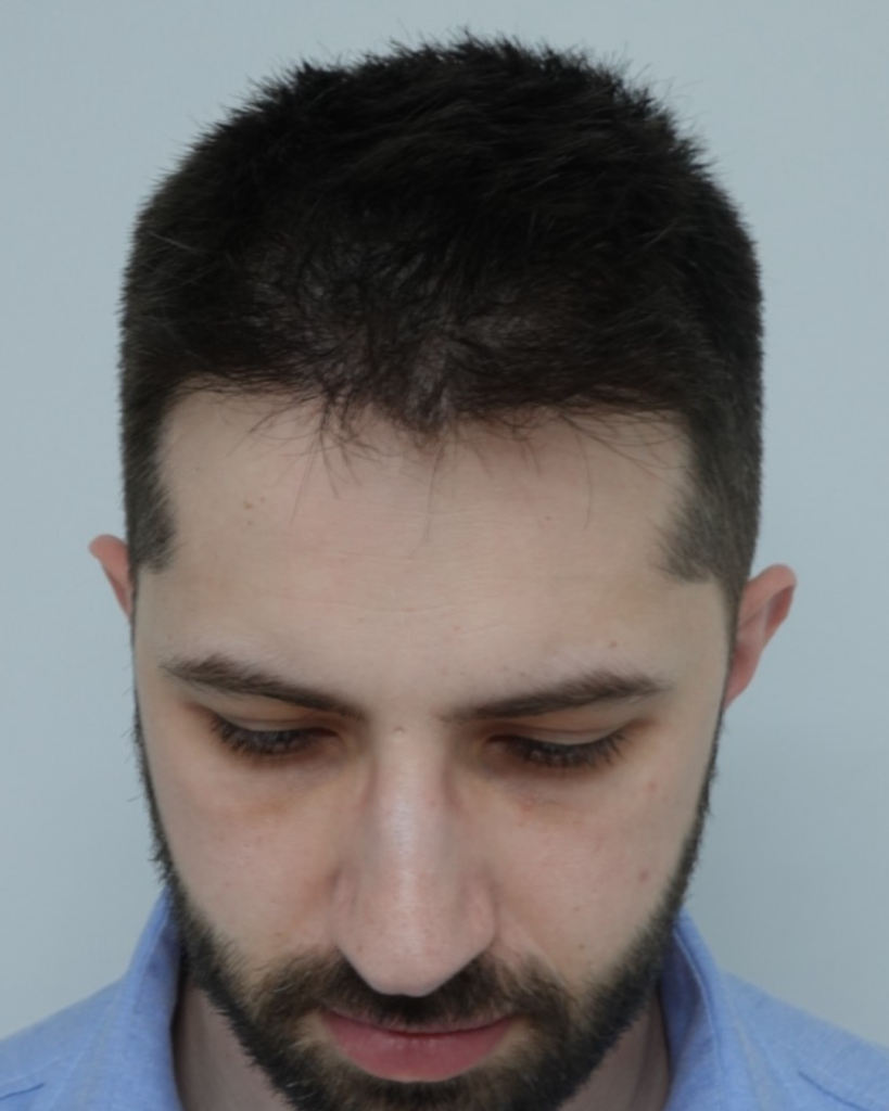 No-Shave FUE, 2487 grafts, after