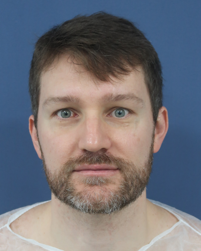 No-Shave FUE, 2300 grafts, before