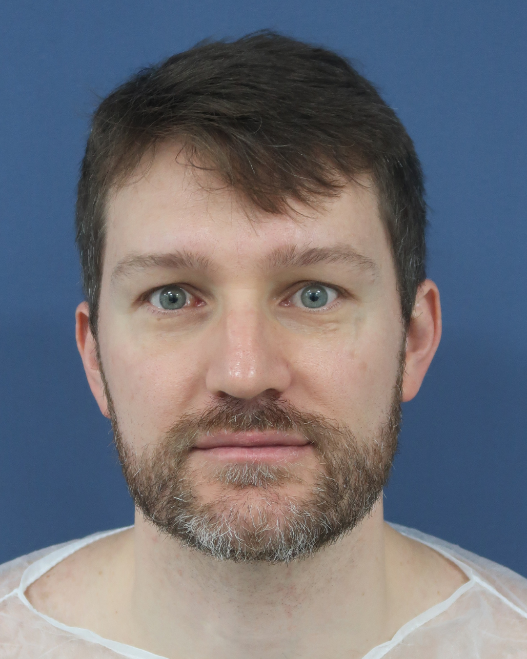 No-Shave FUE, 2300 grafts, before