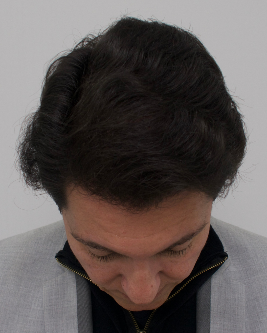 No-Shave FUE, 5000 grafts, after