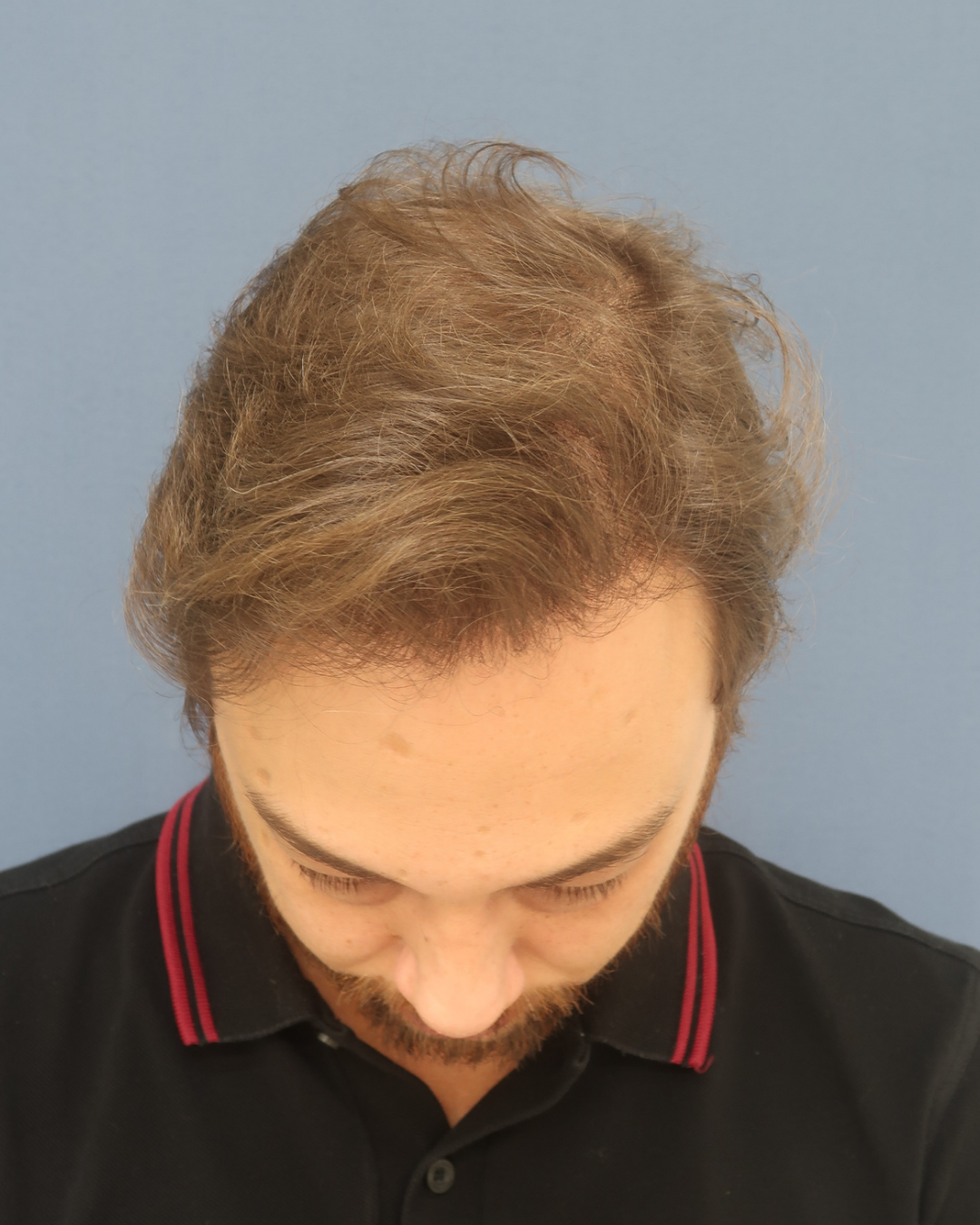 No-Shave FUE, 4580 grafts, after