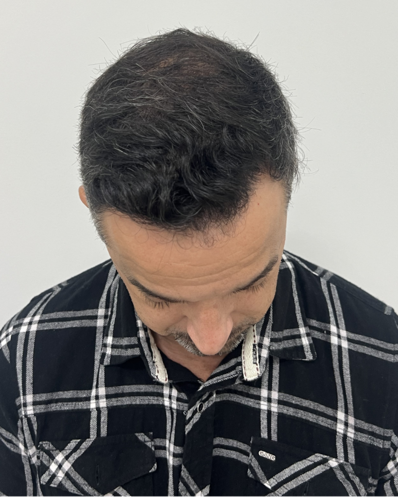 No-Shave FUE, 4000 grafts, after