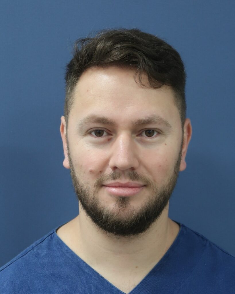 Resultado de transplante capilar antes e depois na Clínica Câmara Lopes no Brasil 8
