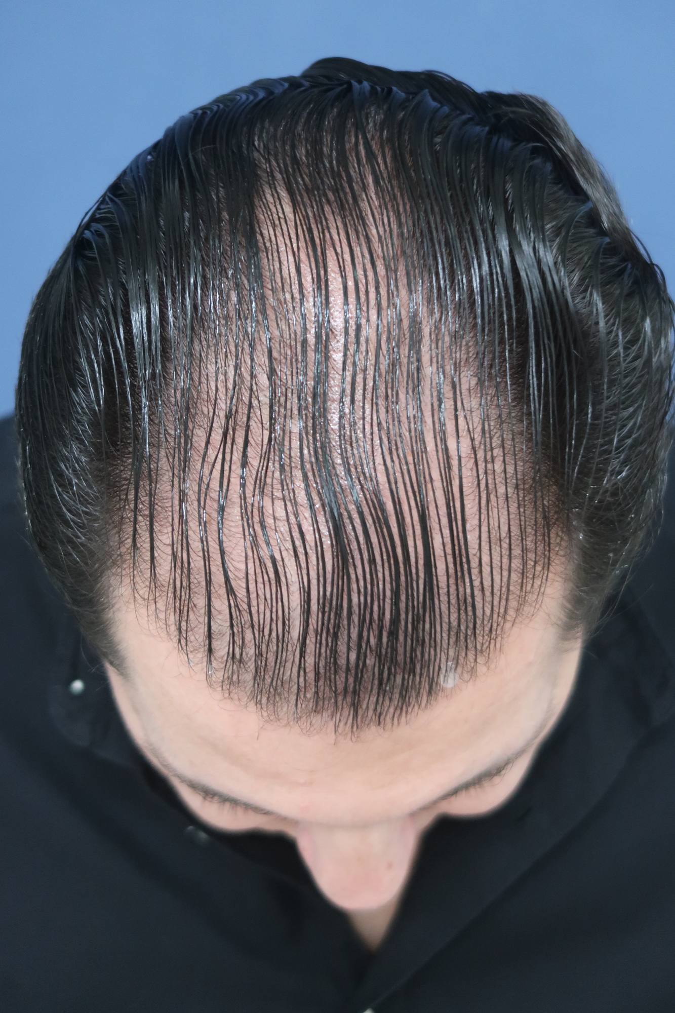 No-Shave FUE, 5000 grafts, before
