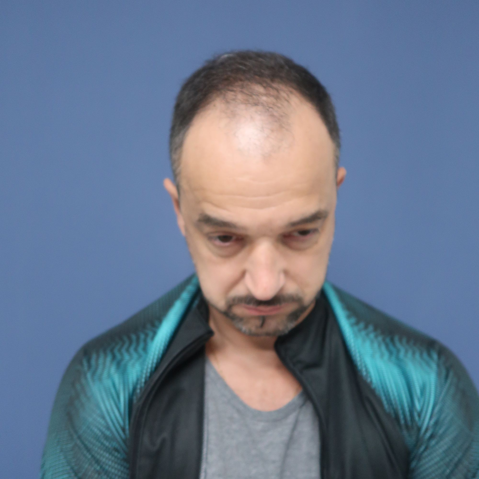 No-Shave FUE, 4000 grafts, BEFORE