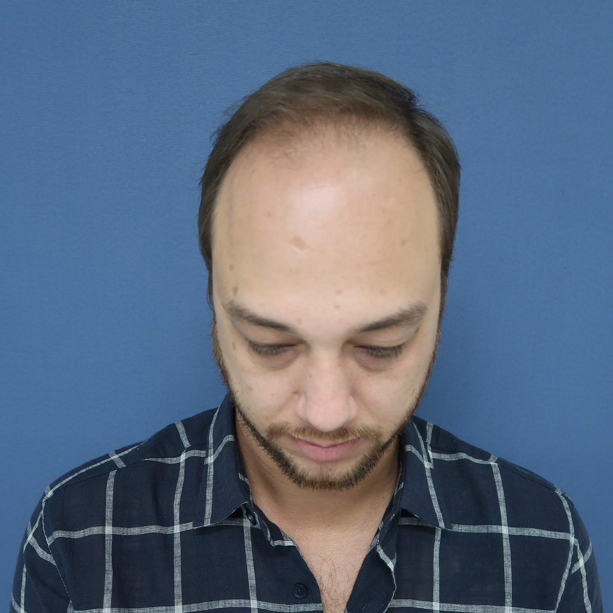 No-Shave FUE, 4580 grafts, before