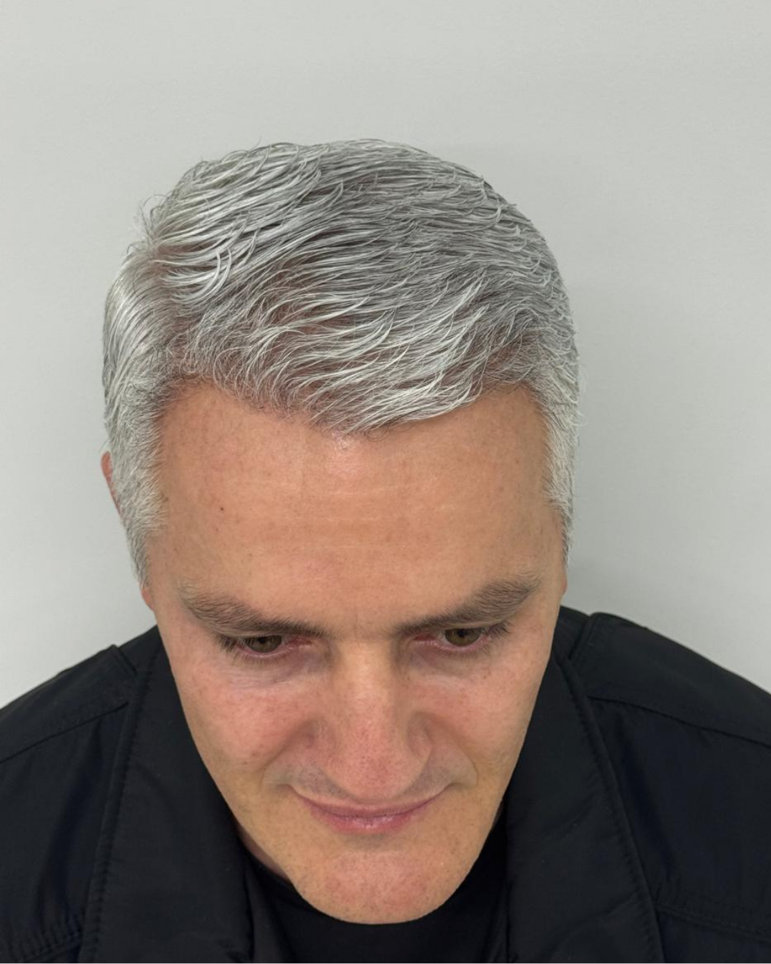 No-Shave FUE, 3700 grafts, after