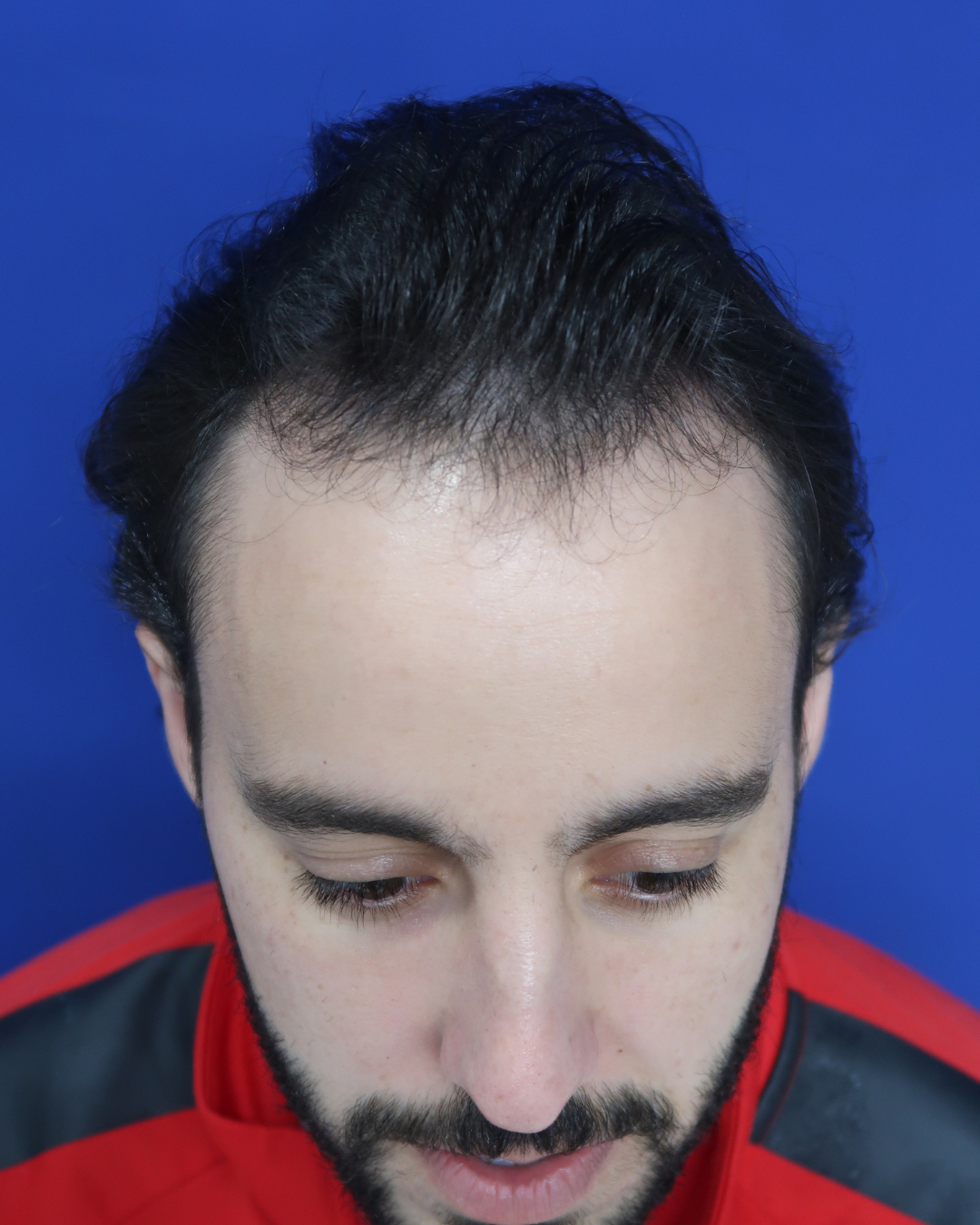 No-Shave FUE, 3600 grafts, before