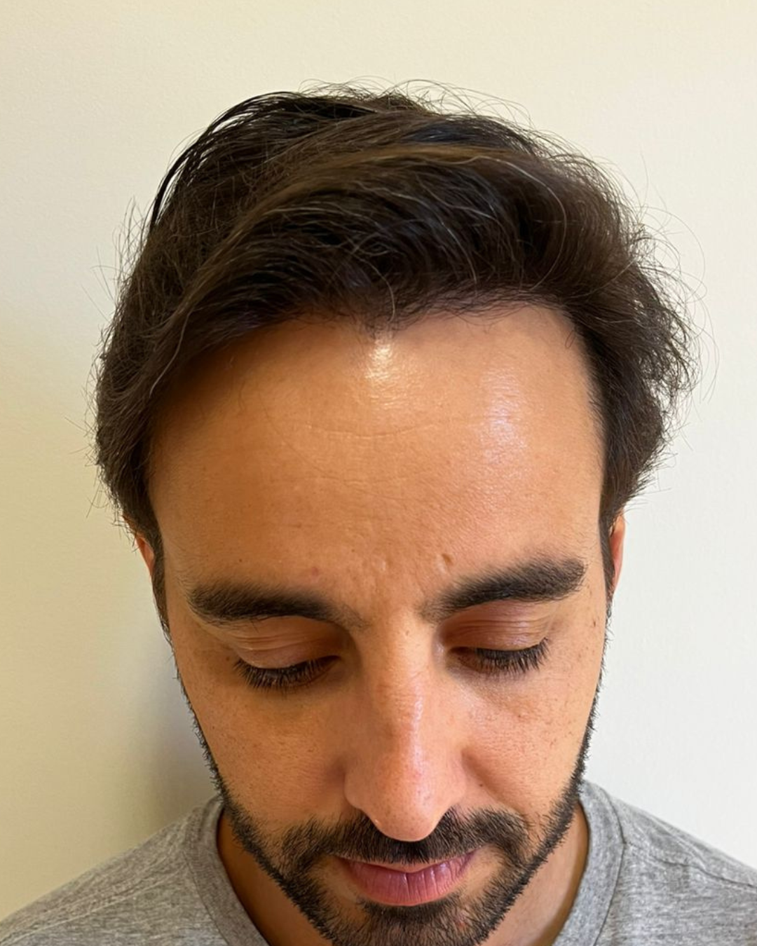 No-Shave FUE, 3600 grafts, after