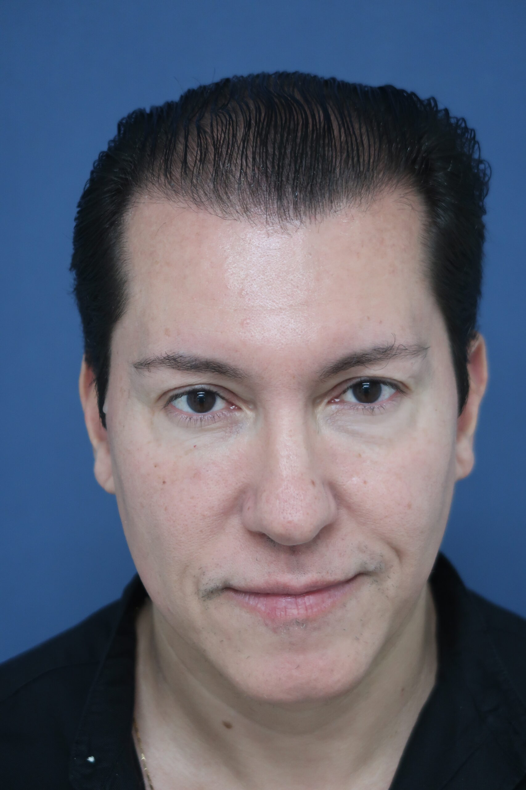 No-Shave FUE, 5000 grafts, BEFORE