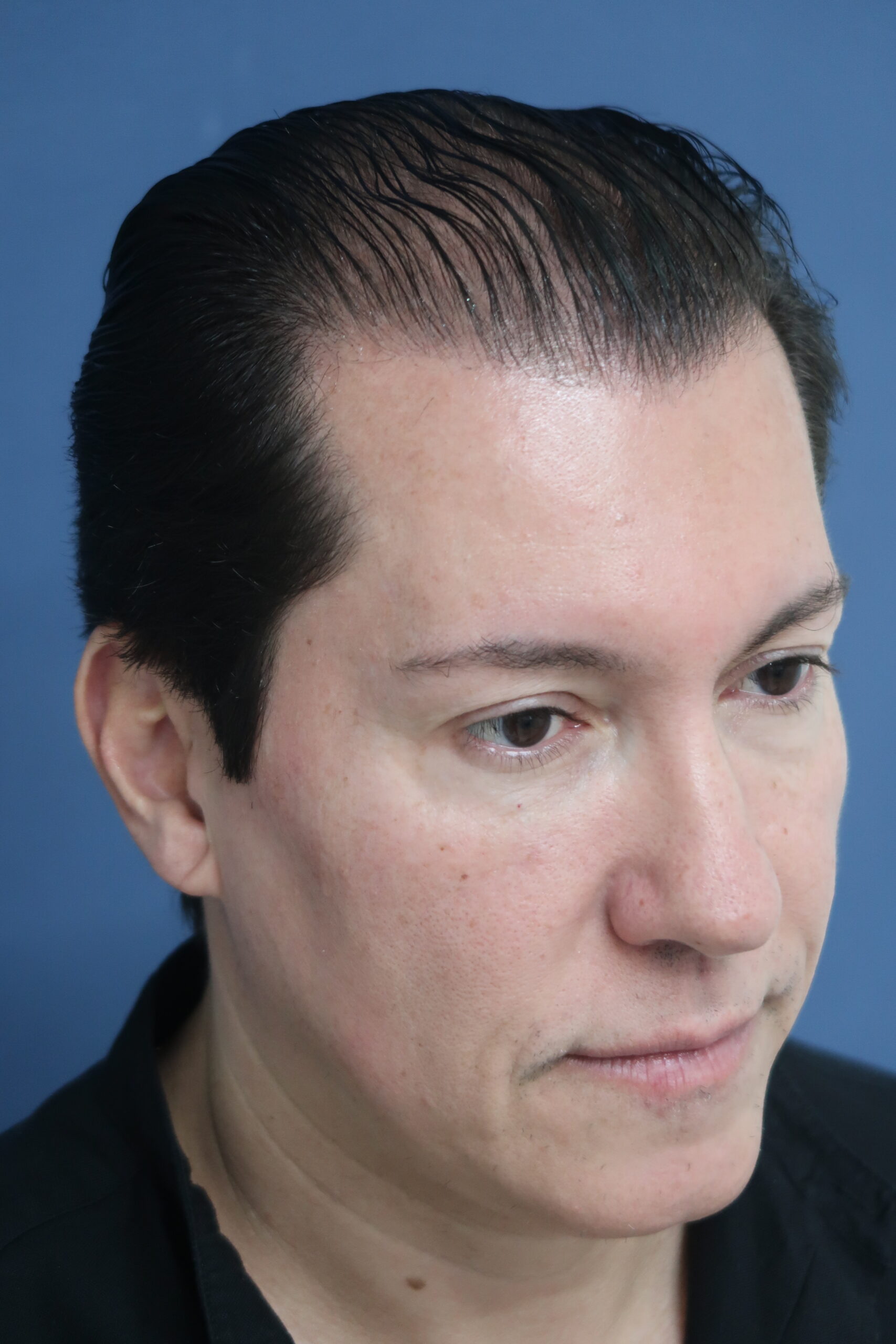 No-Shave FUE, 5000 grafts, photo 7 of 26