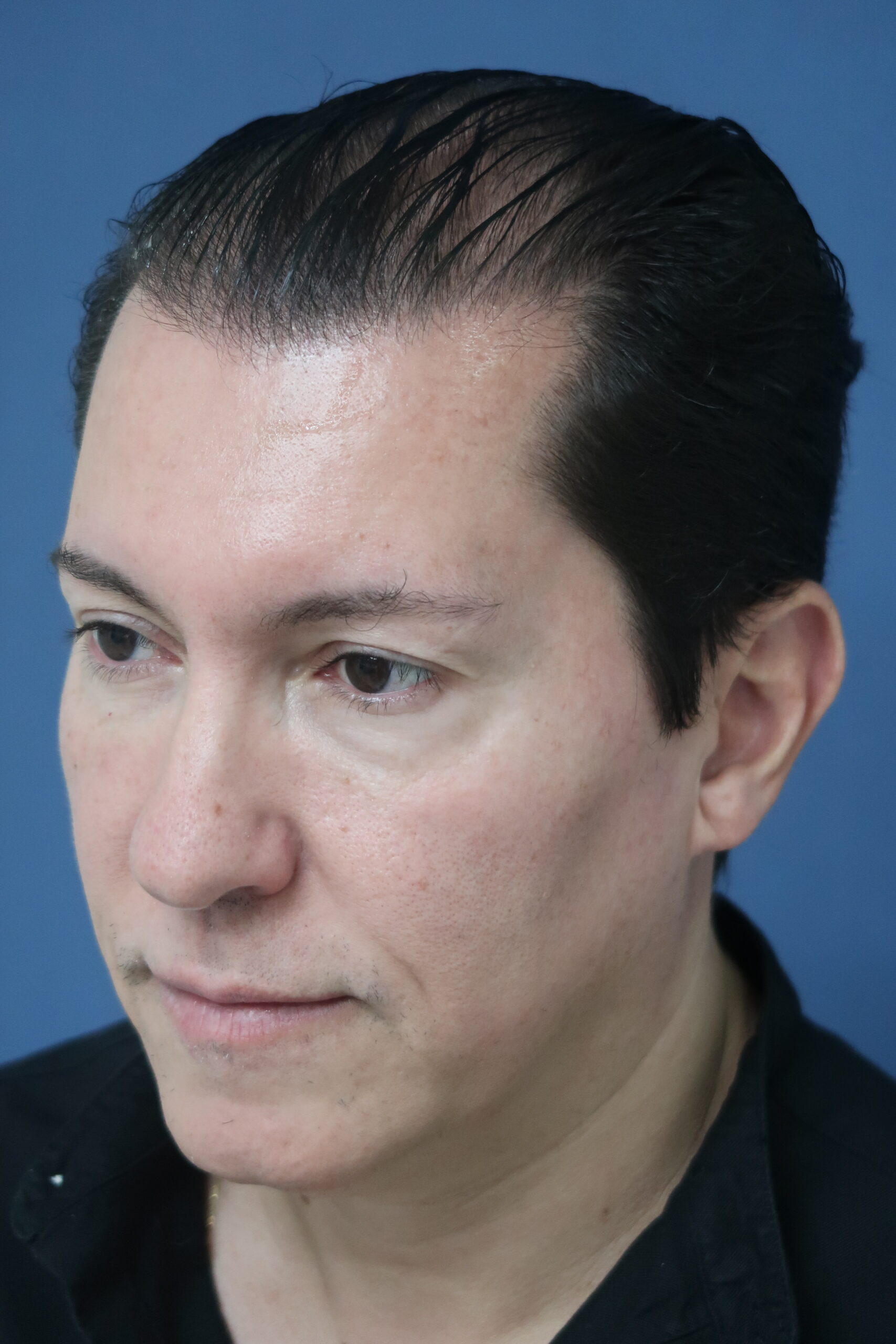 No-Shave FUE, 5000 grafts, photo 6 of 26