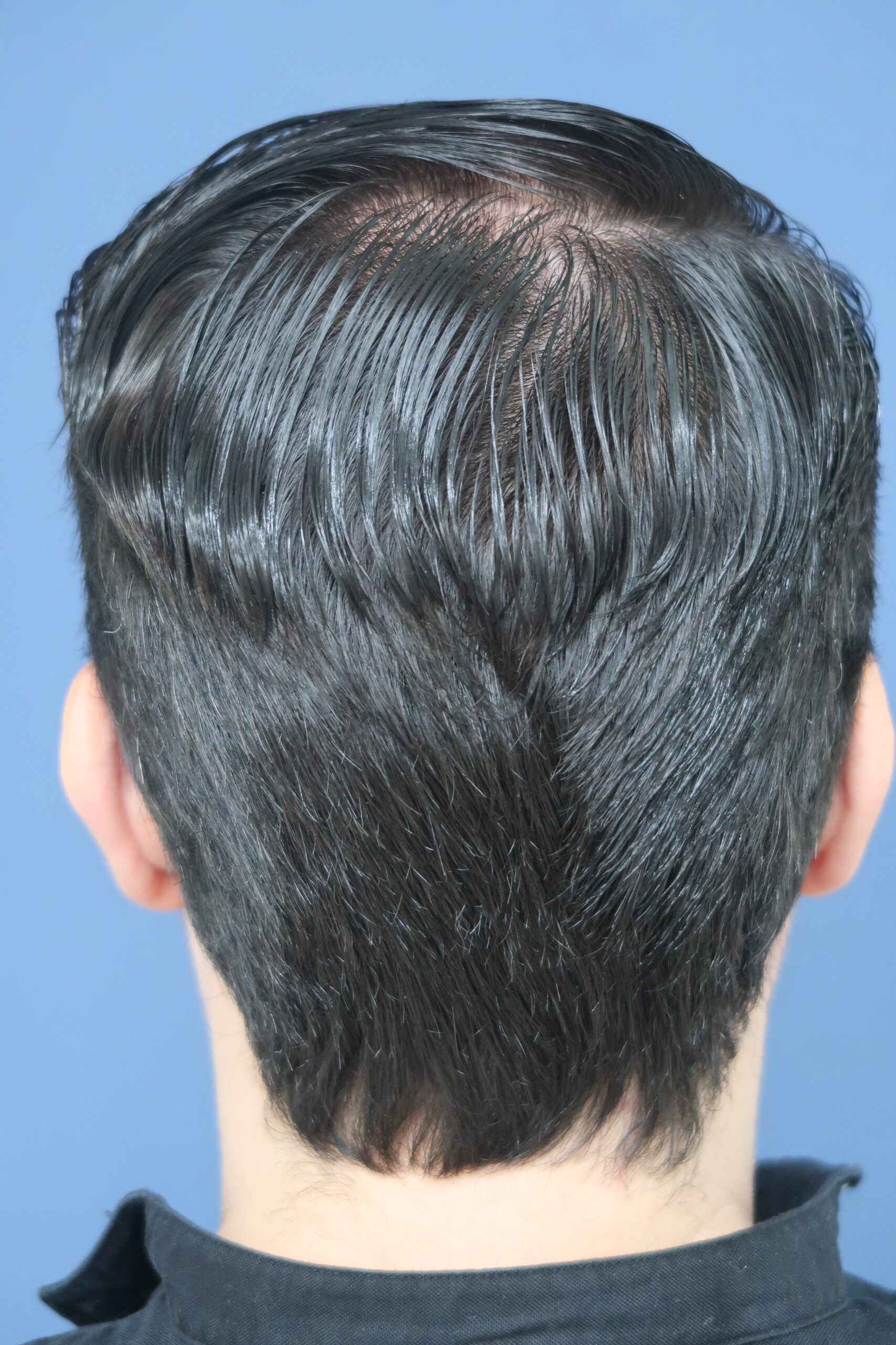 No-Shave FUE, 5000 grafts, POST-OP