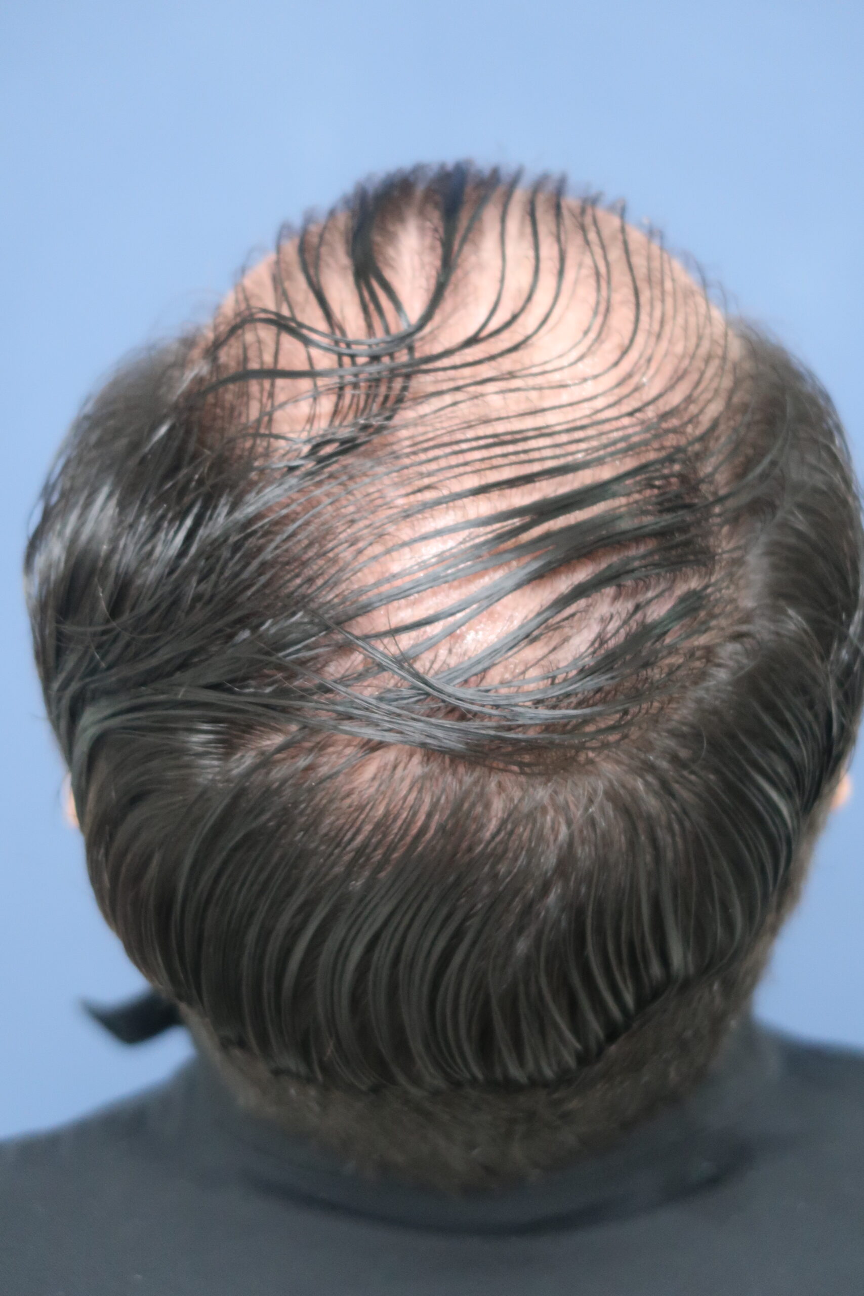 No-Shave FUE, 5000 grafts, photo 5 of 26