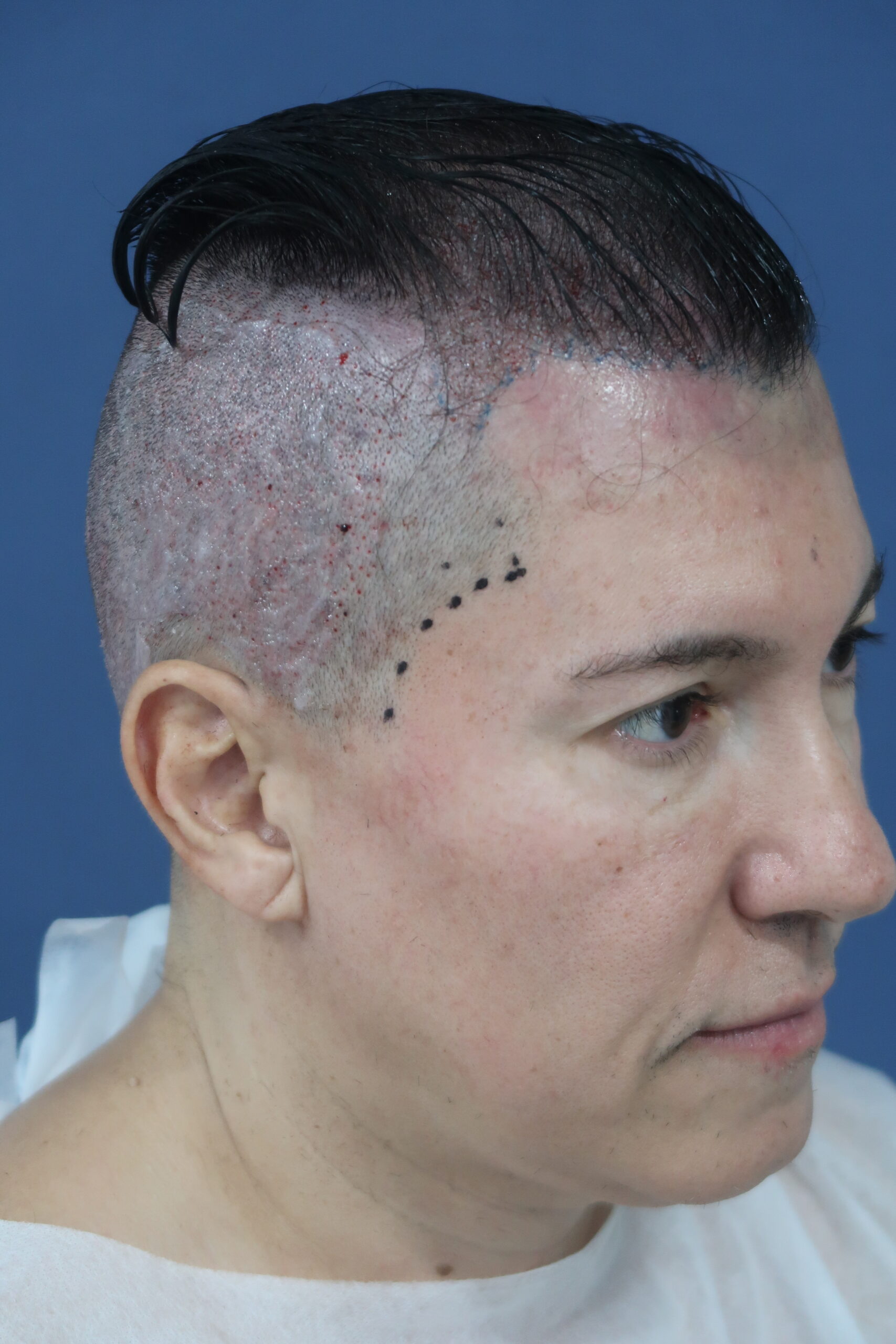 No-Shave FUE, 5000 grafts, photo 13 of 26
