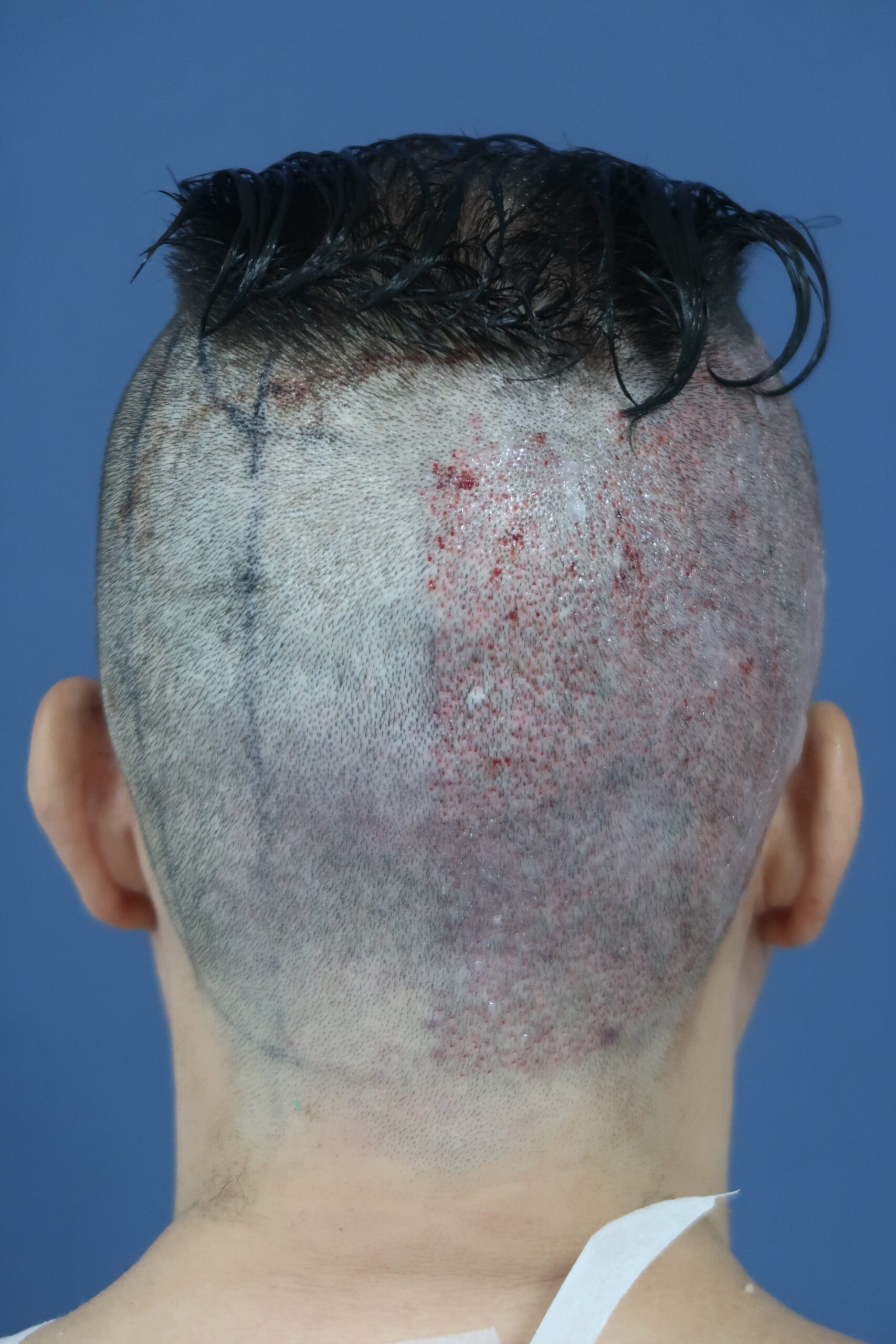 No-Shave FUE, 5000 grafts, photo 14 of 26