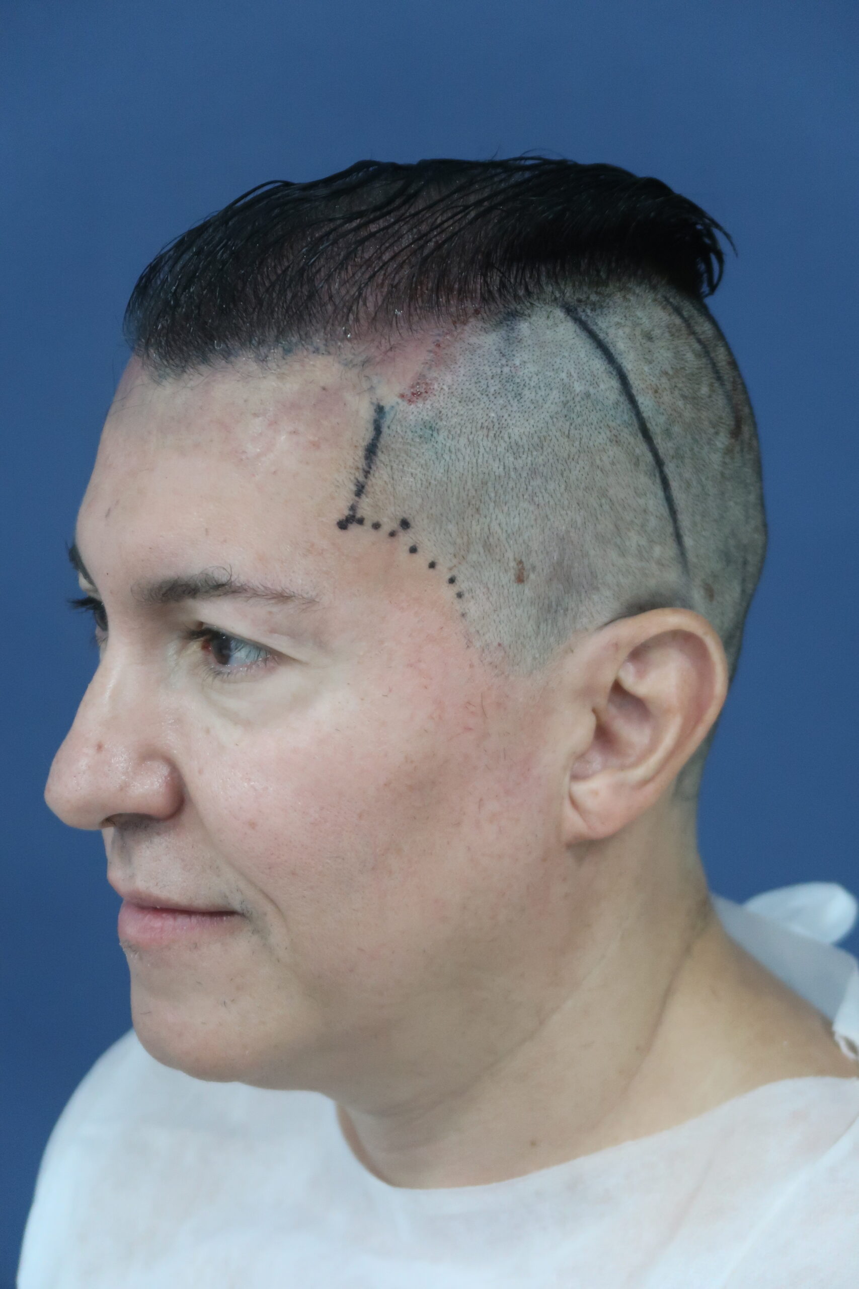 No-Shave FUE, 5000 grafts, photo 12 of 26