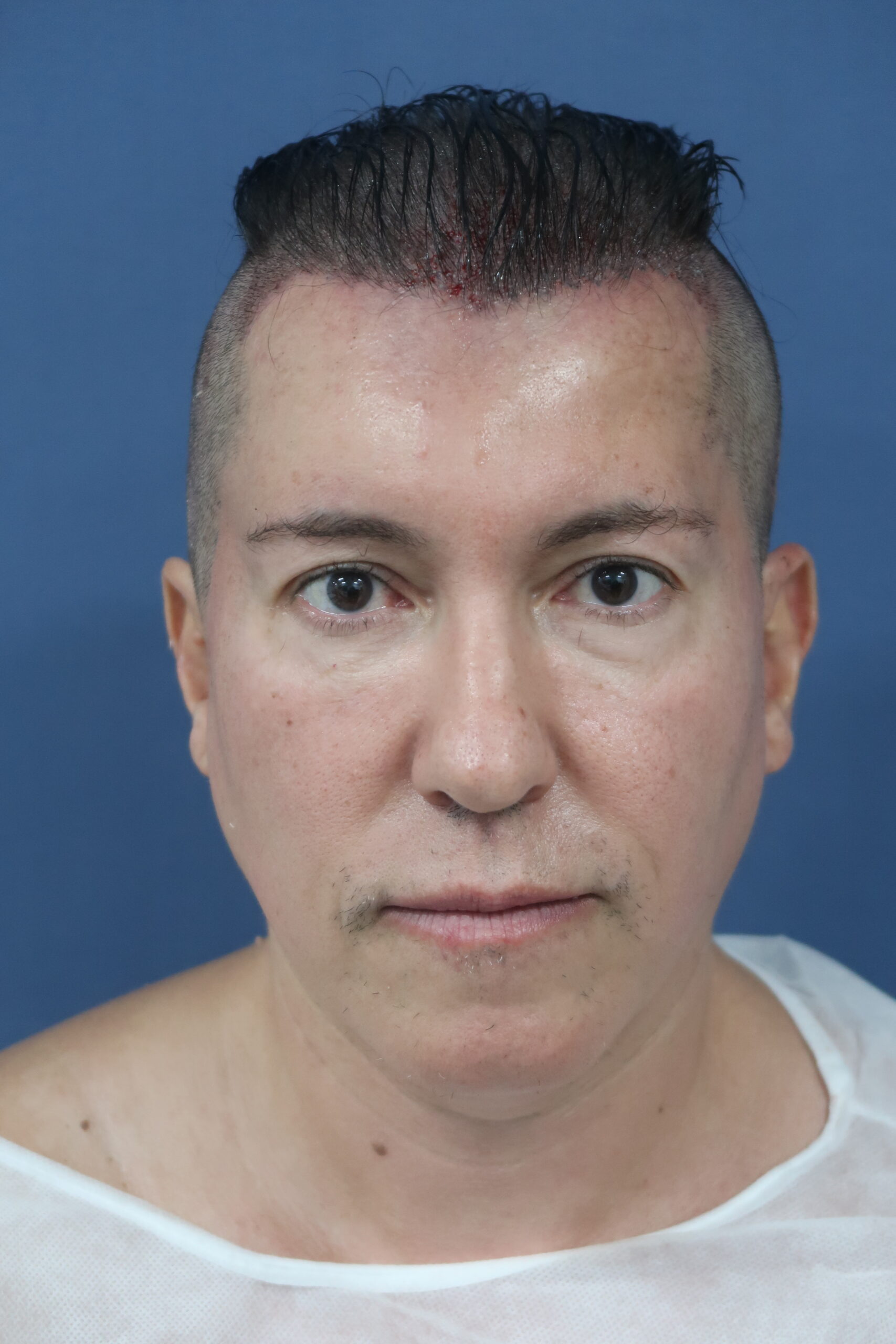 No-Shave FUE, 5000 grafts, photo 9 of 26