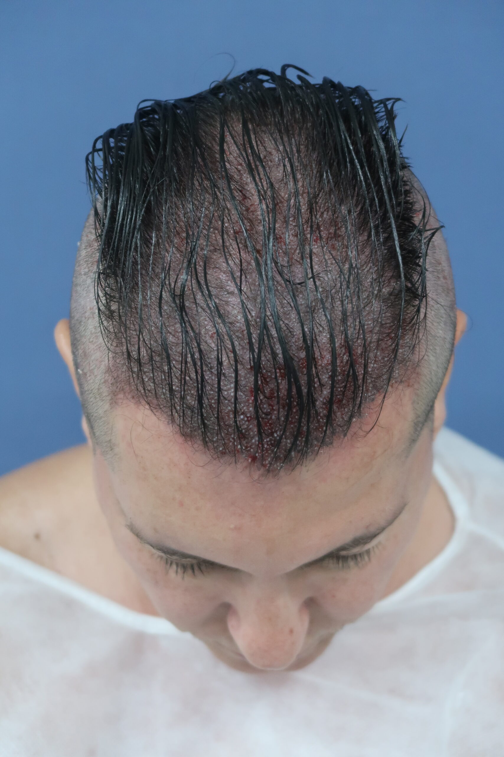 No-Shave FUE, 5000 grafts, photo 10 of 26