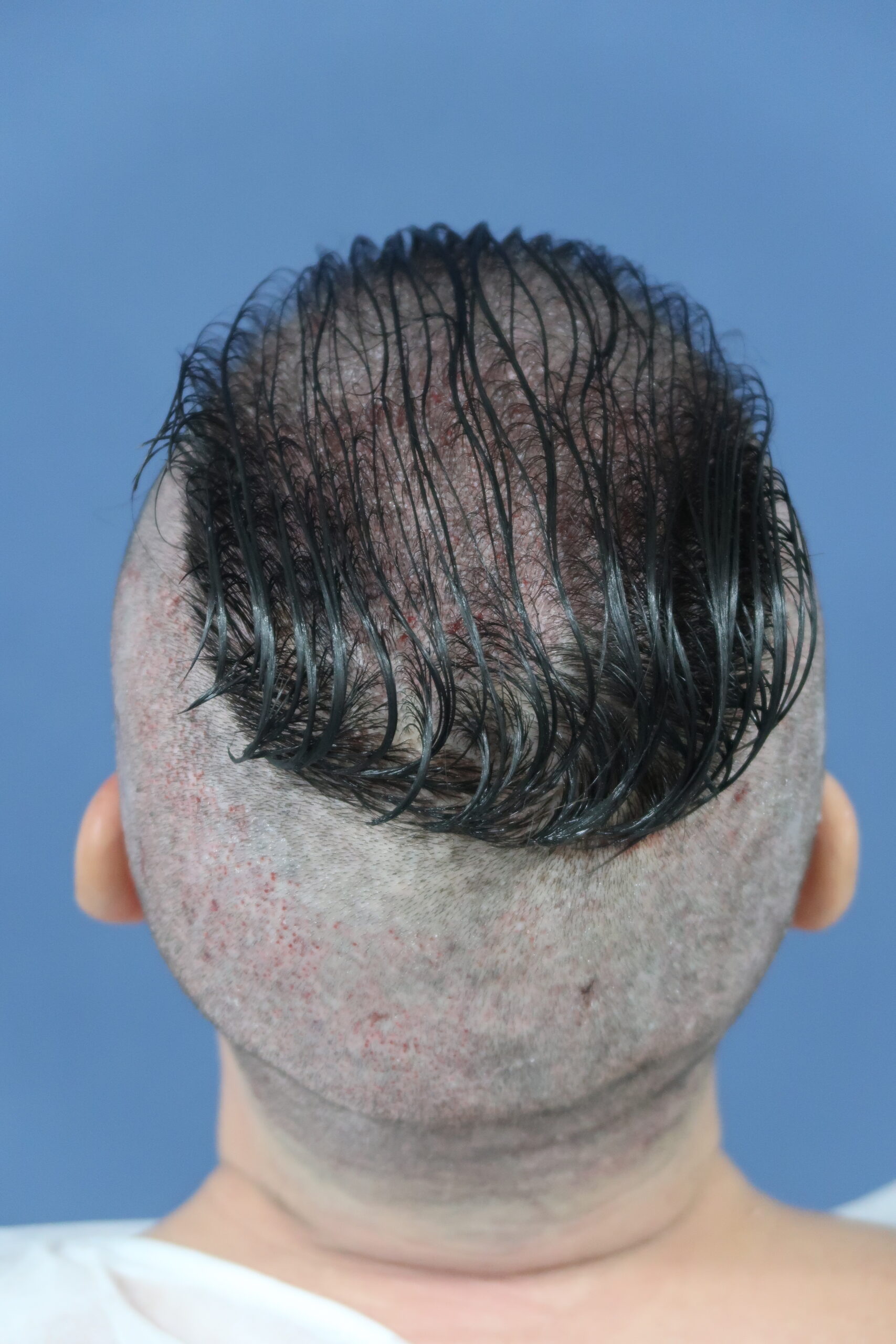 No-Shave FUE, 5000 grafts, photo 11 of 26