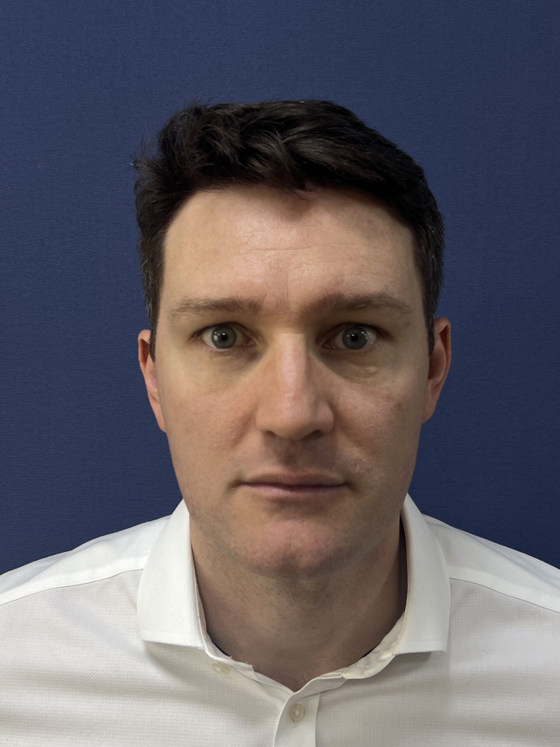 No-Shave FUE, 2300 grafts, photo 16 of 20