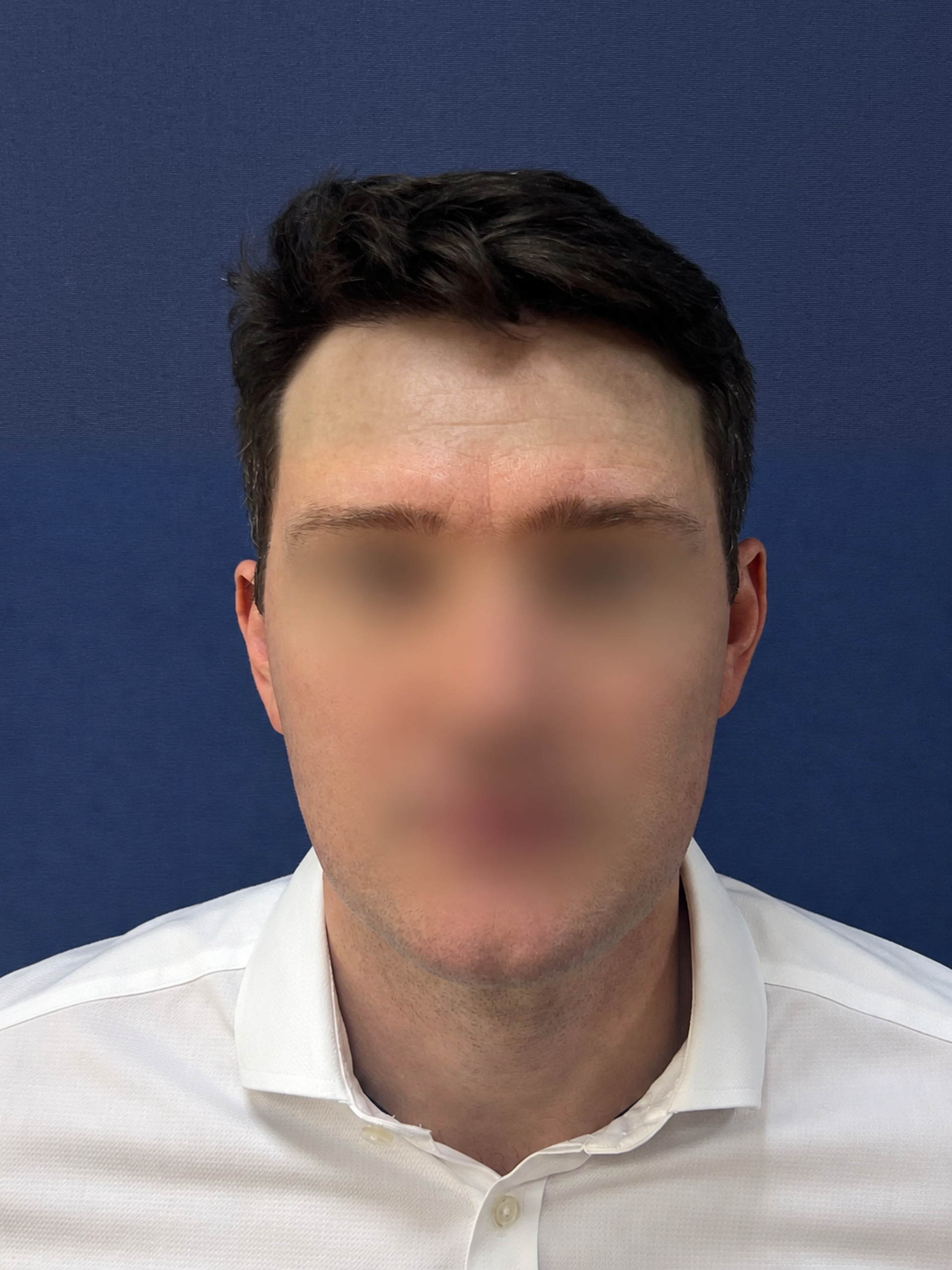 No-Shave FUE, 2300 grafts, photo 16 of 20