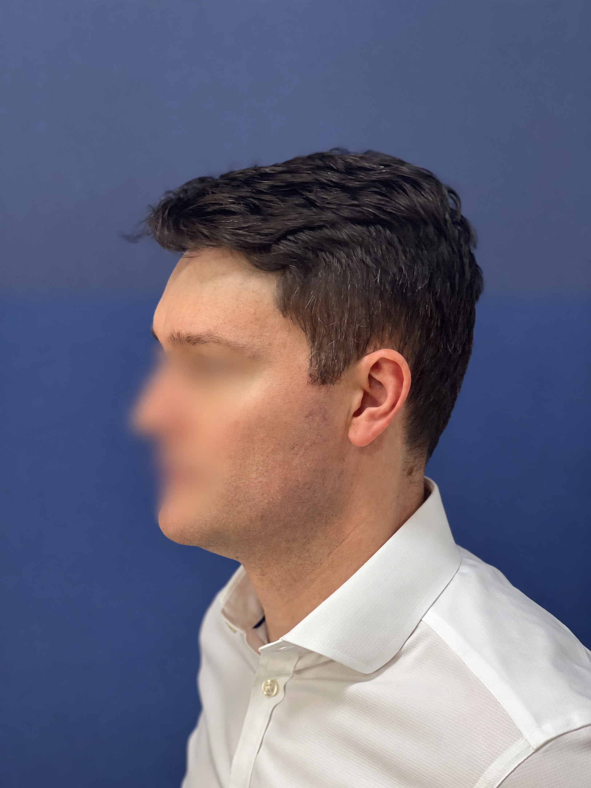 No-Shave FUE, 2300 grafts, photo 17 of 20