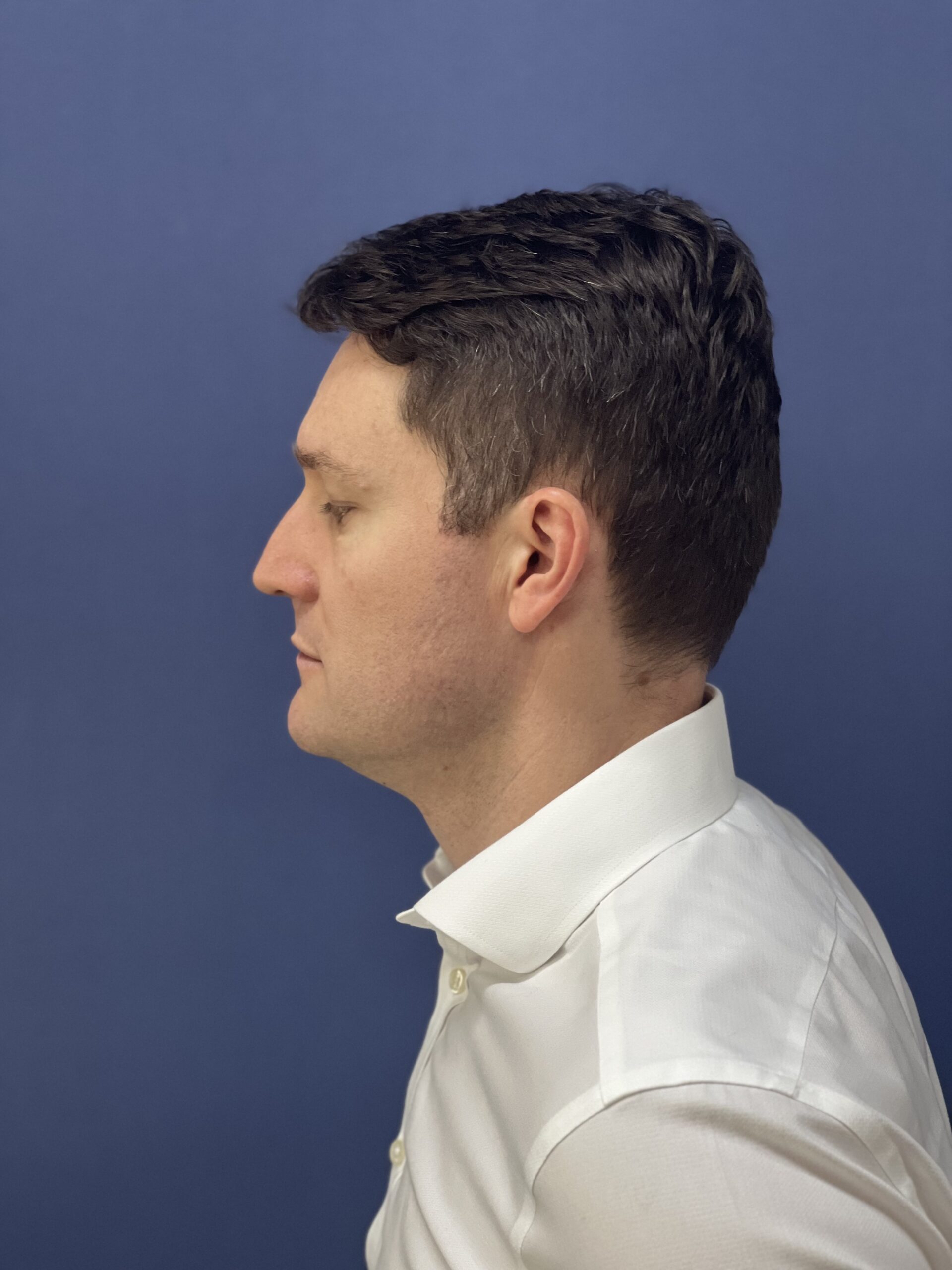 No-Shave FUE, 2300 grafts, photo 19 of 20