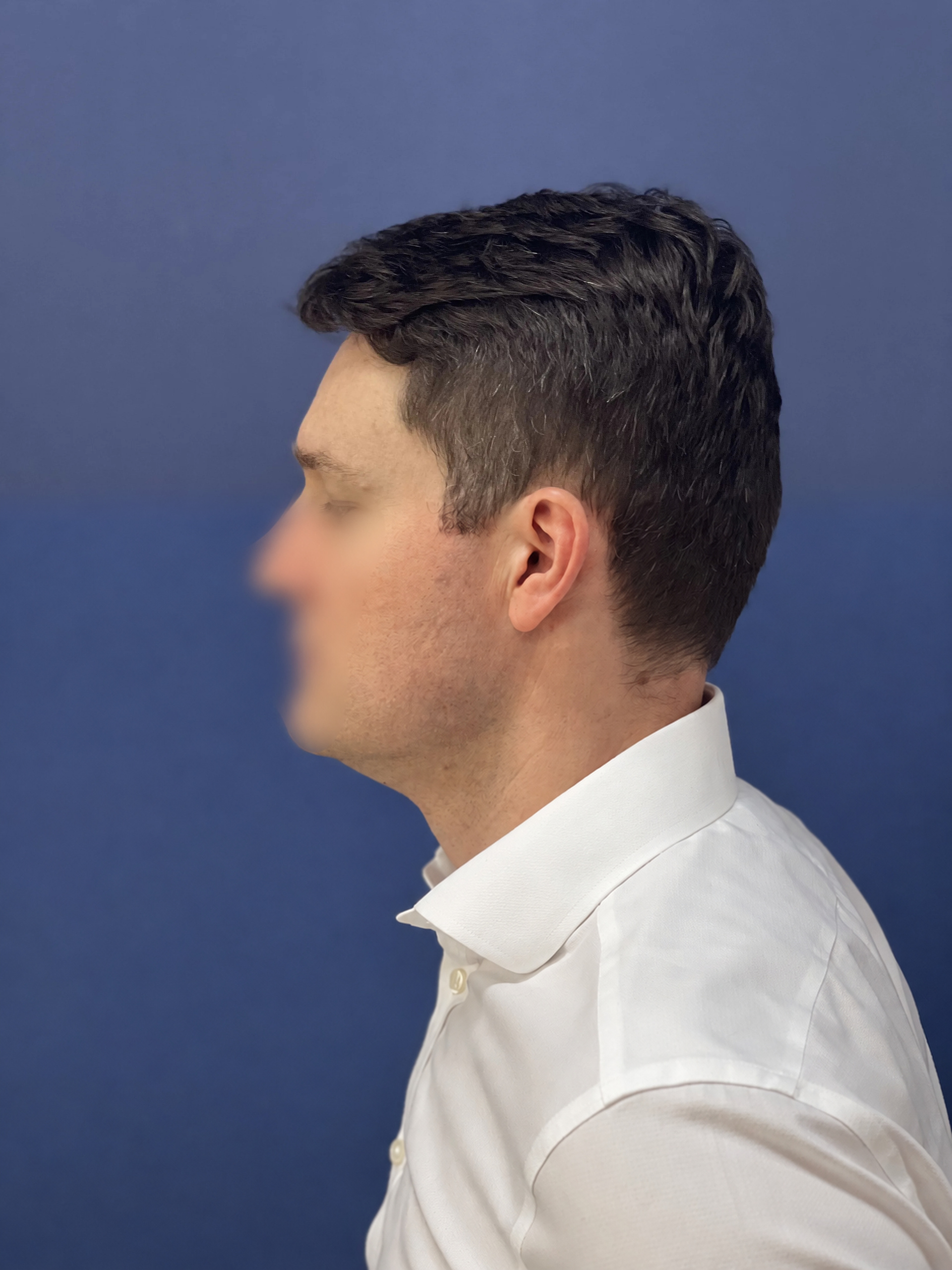No-Shave FUE, 2300 grafts, photo 19 of 20