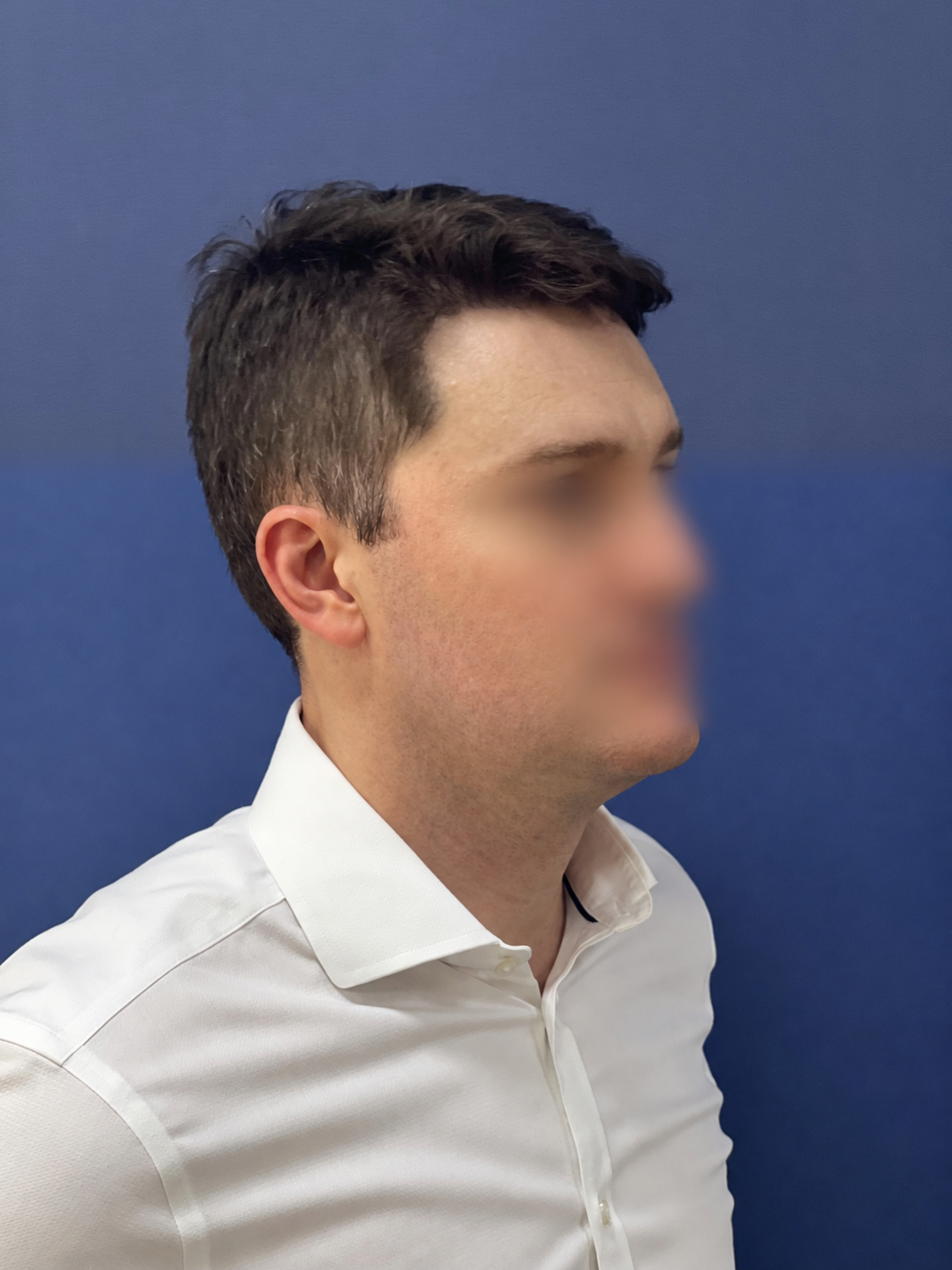 No-Shave FUE, 2300 grafts, photo 18 of 20